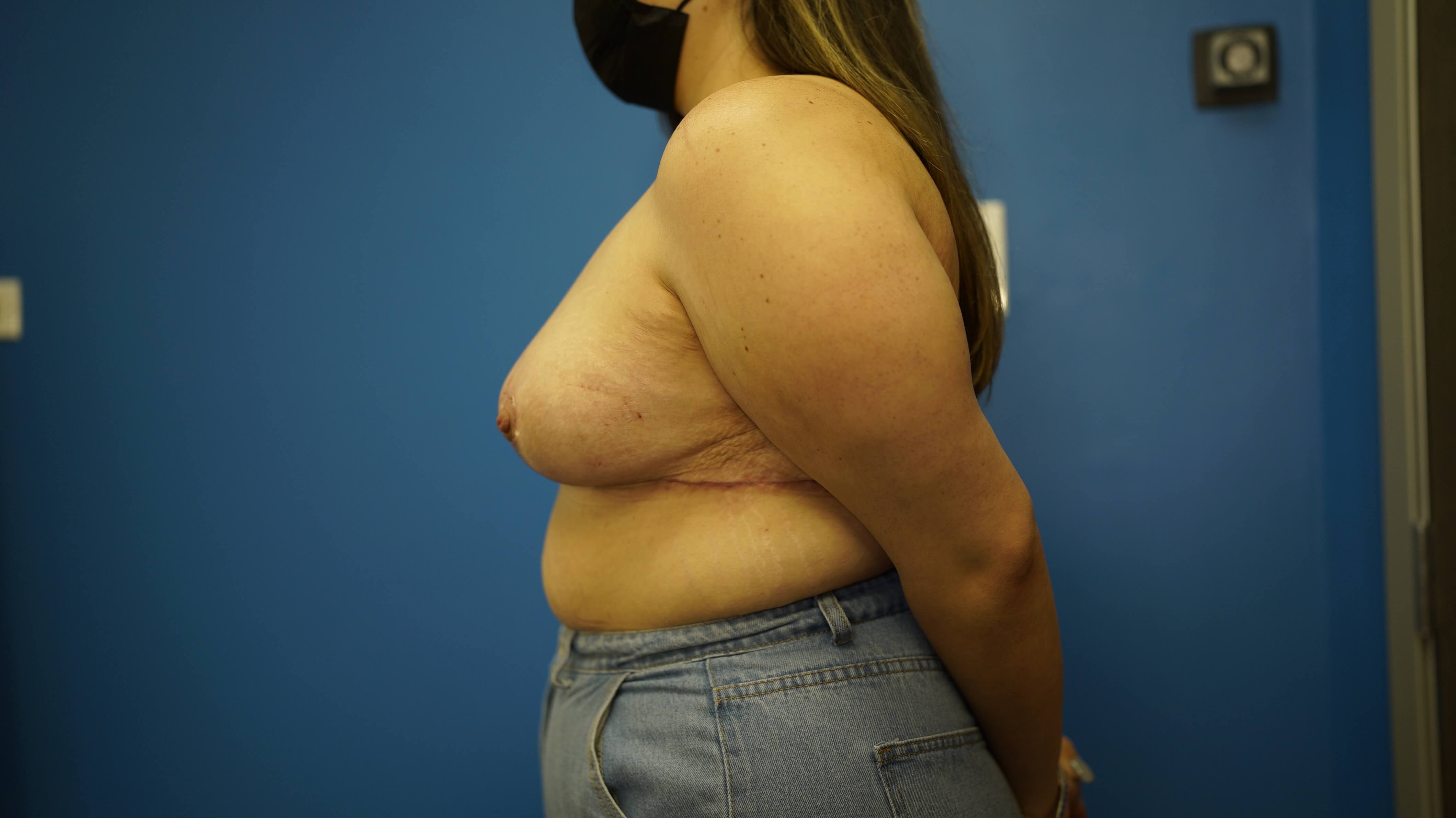 Woman has Breast Lift After