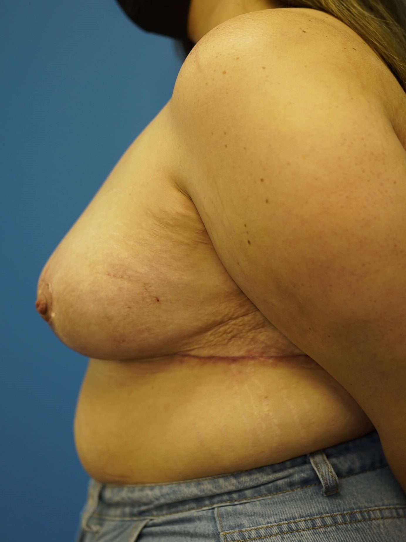 Woman has Breast Lift After