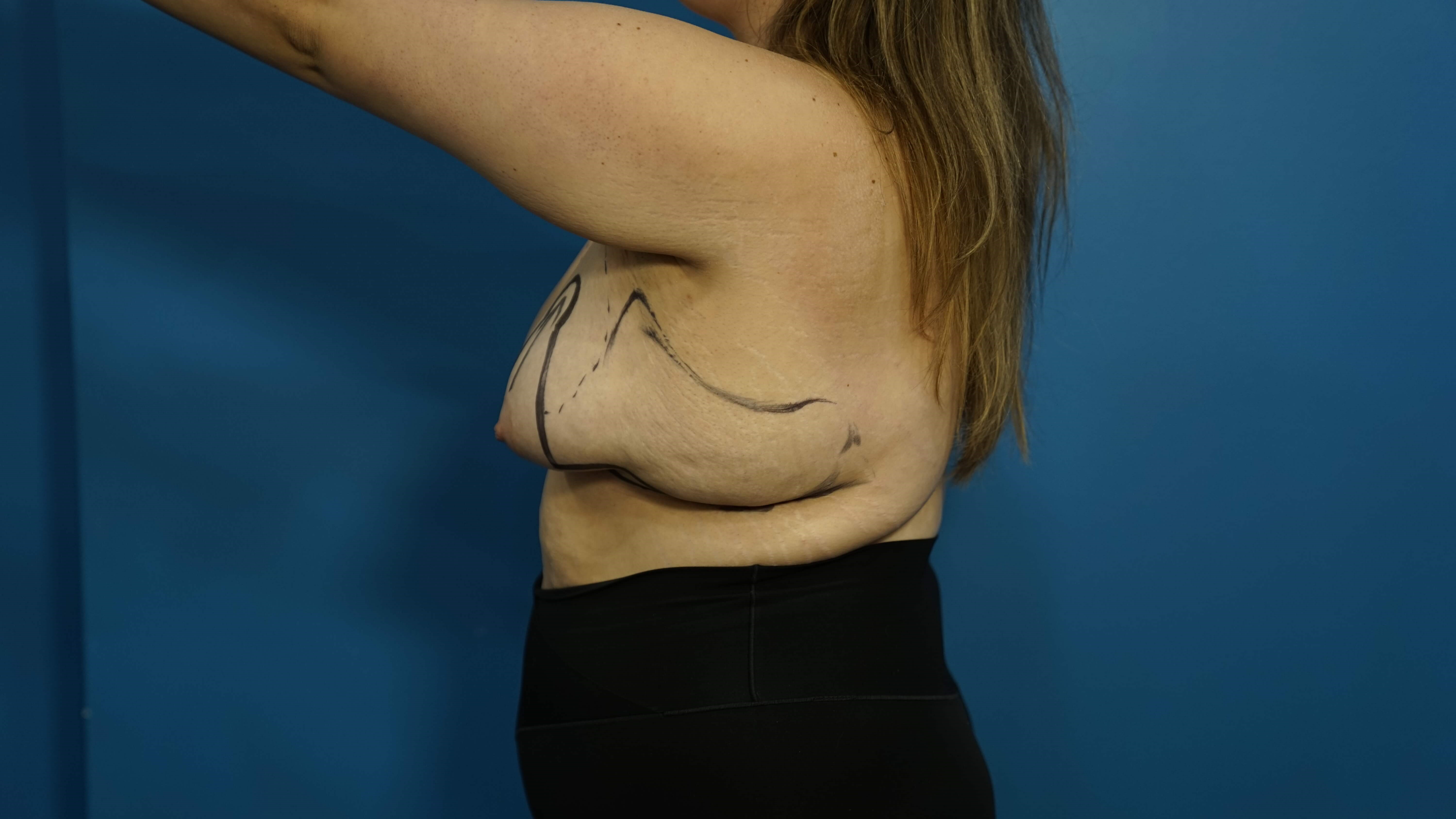 Woman has Breast Lift Before
