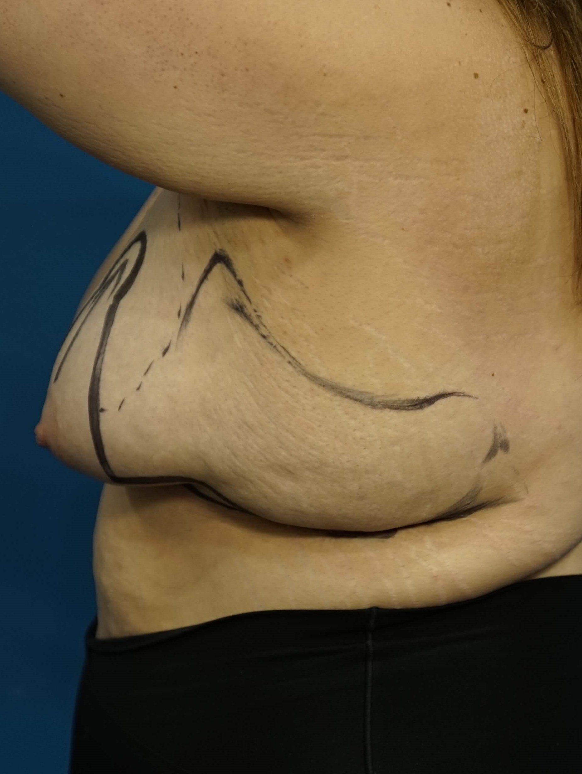 Woman has Breast Lift Before