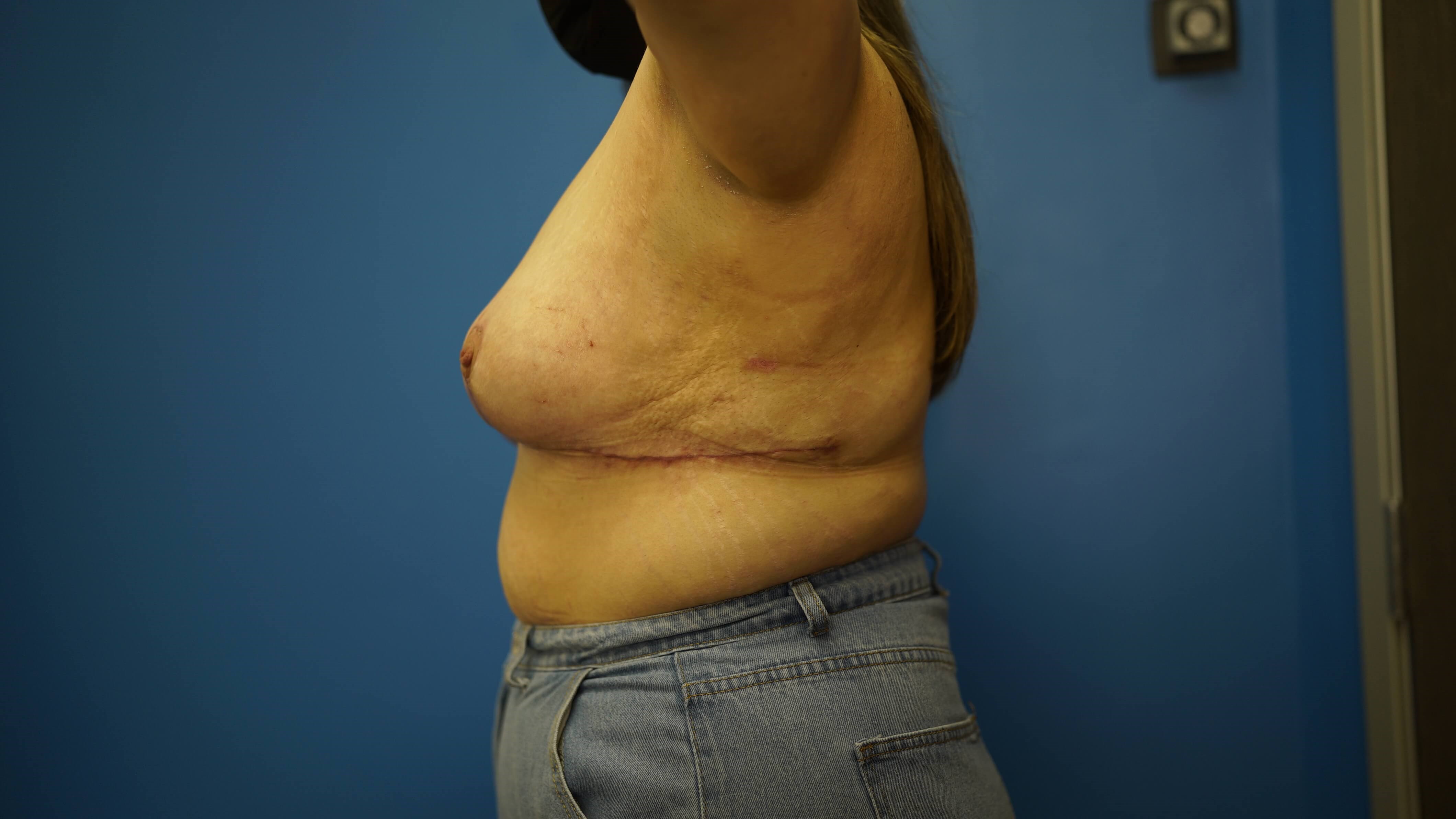 Woman has Breast Lift After