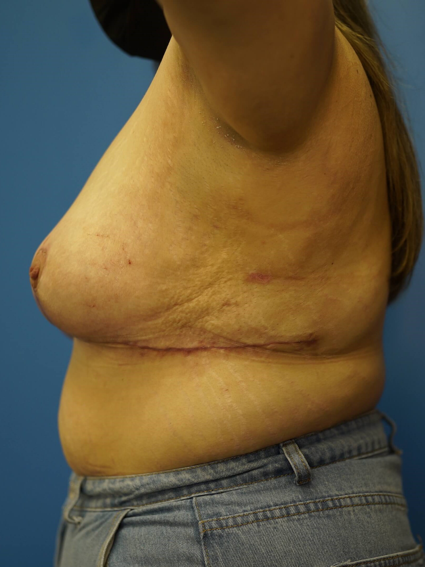 Woman has Breast Lift After