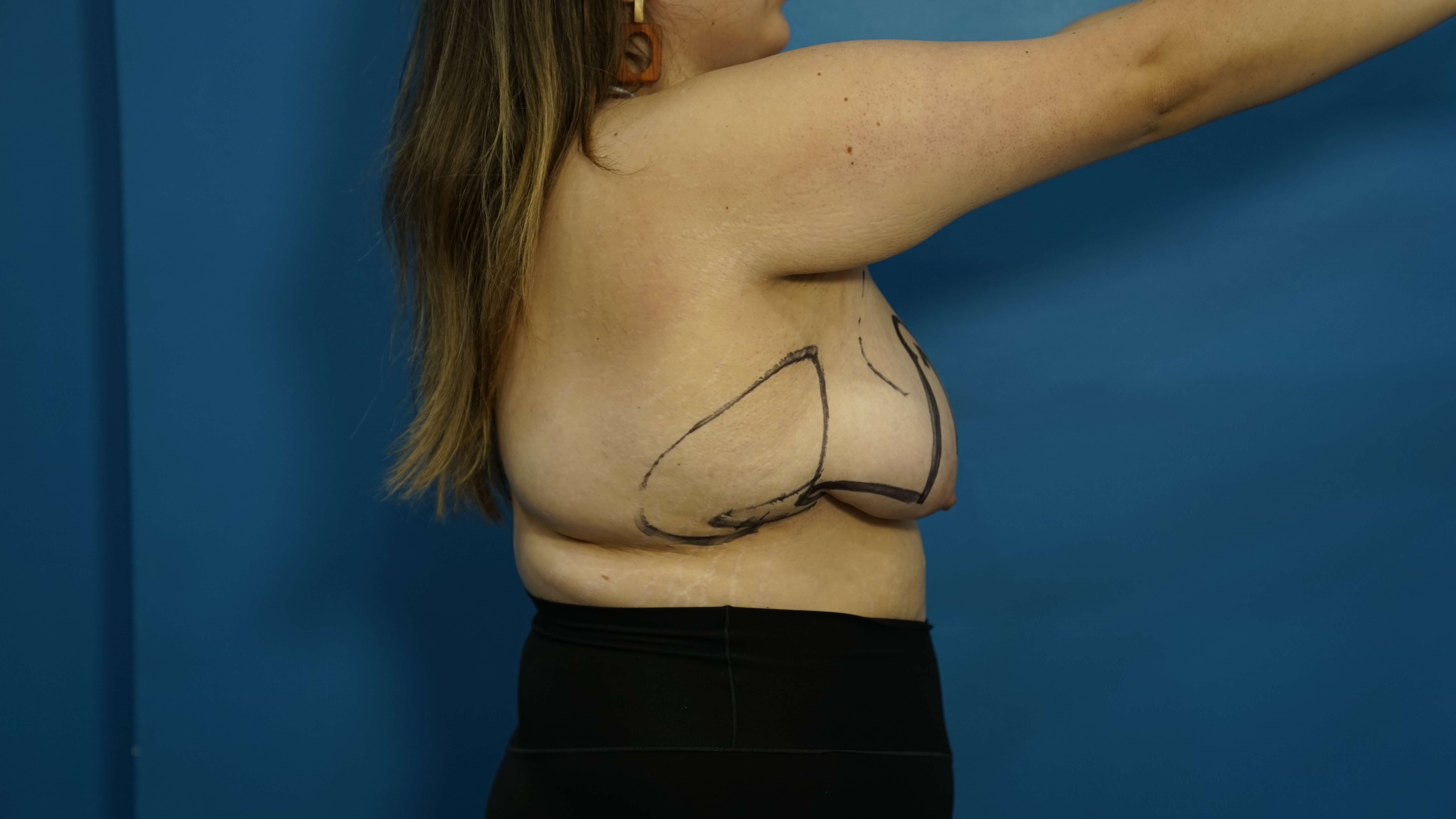 Woman has Breast Lift Before