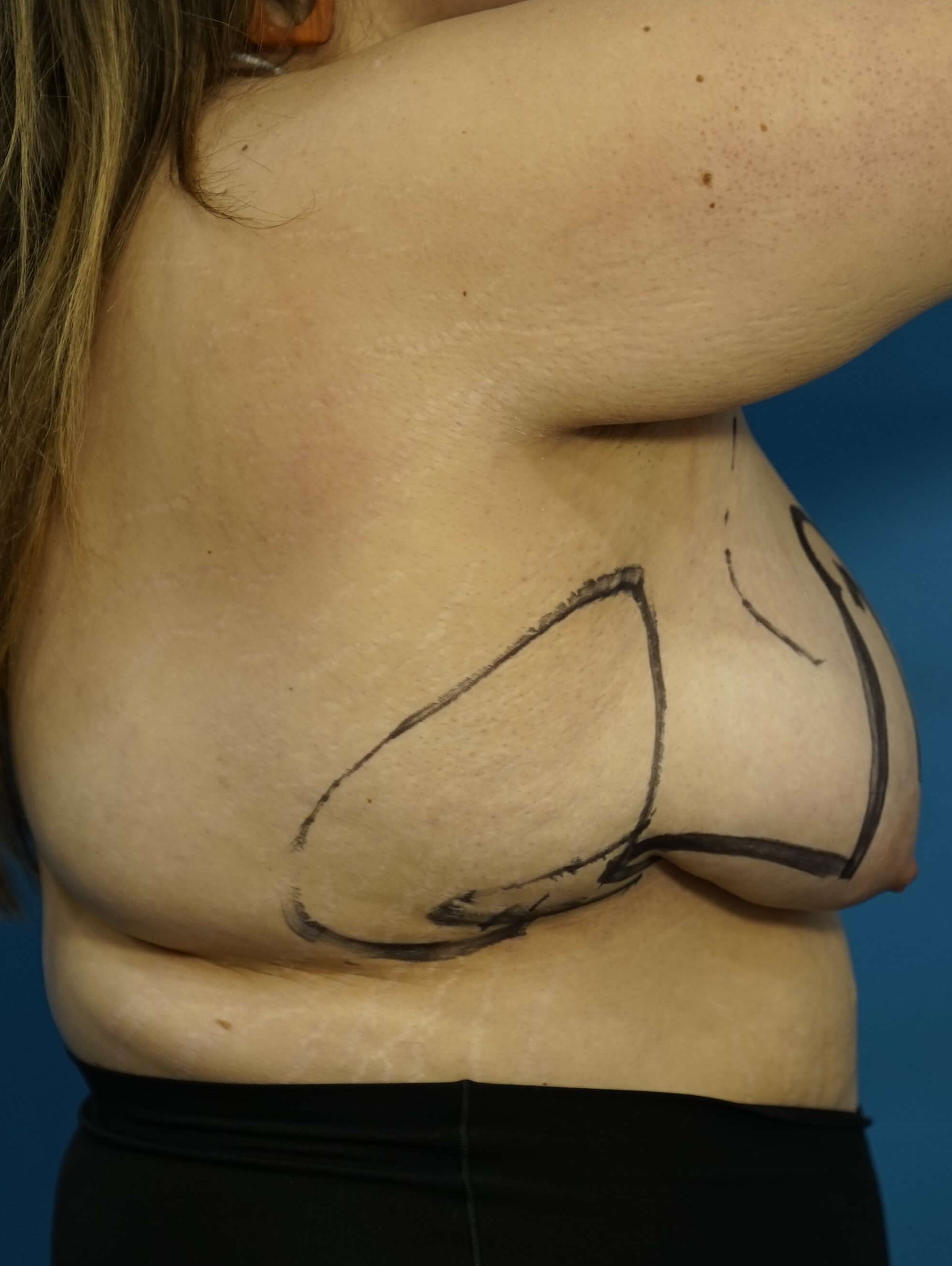 Woman has Breast Lift Before