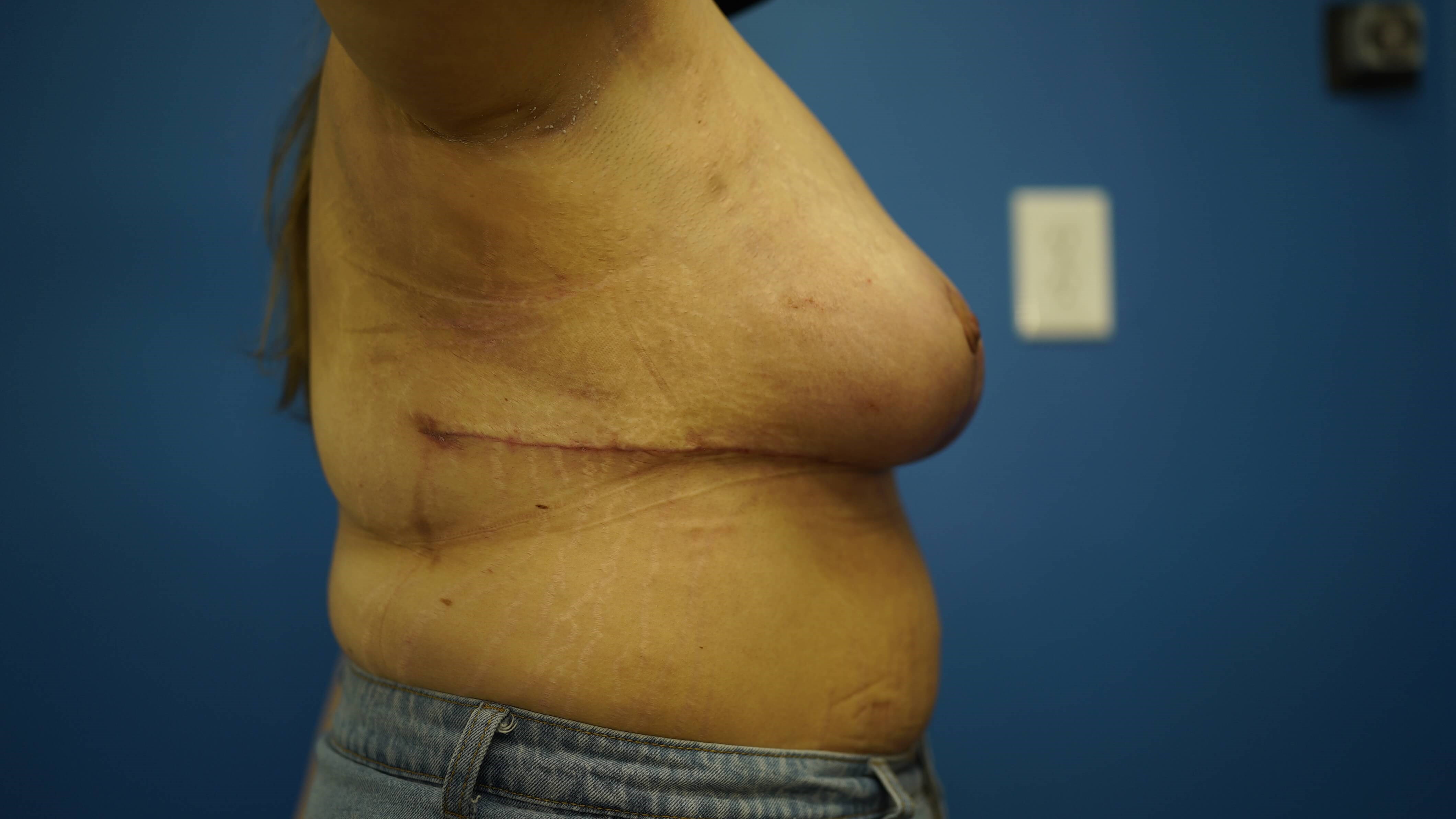 Woman has Breast Lift After