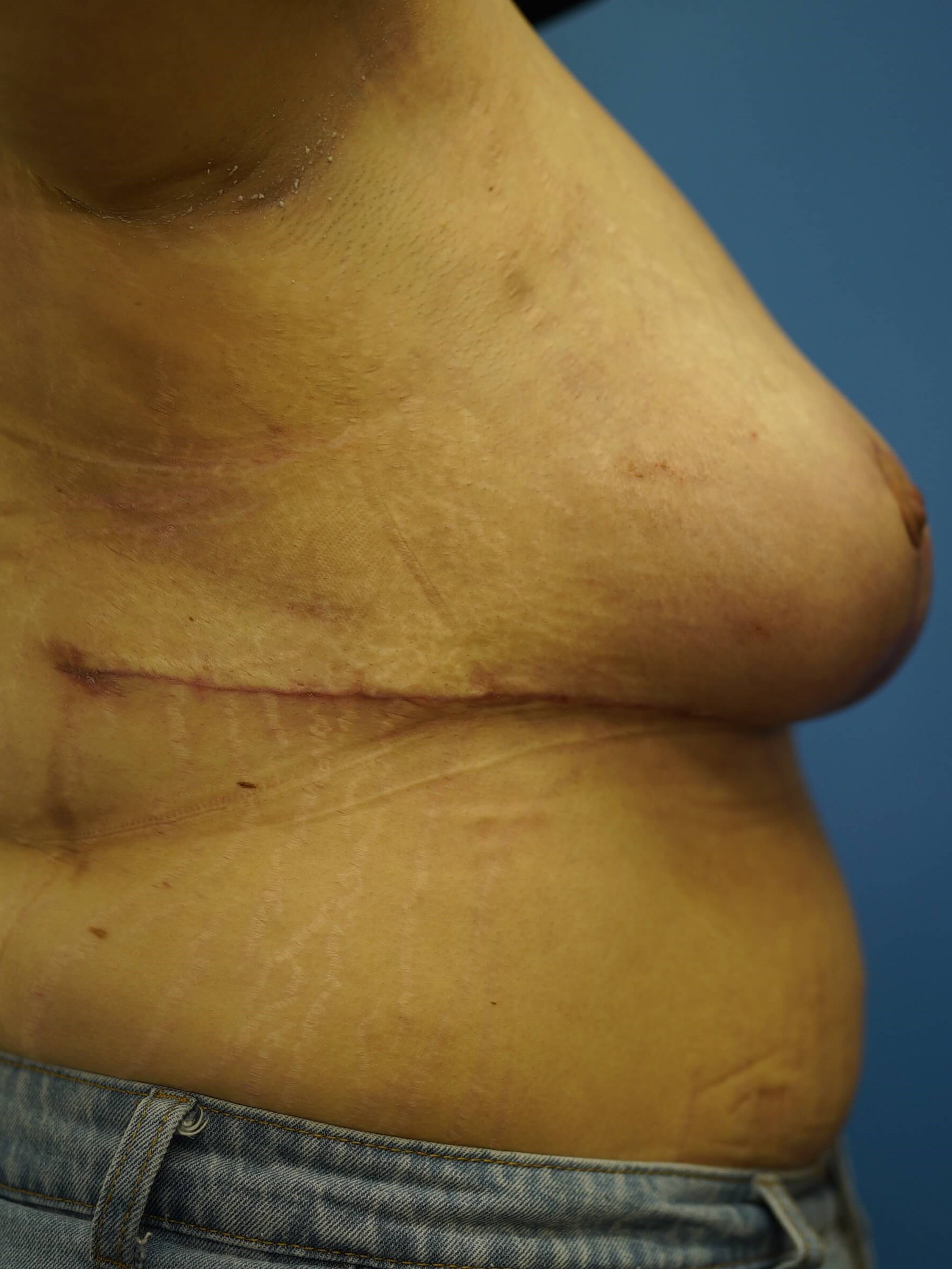 Woman has Breast Lift After
