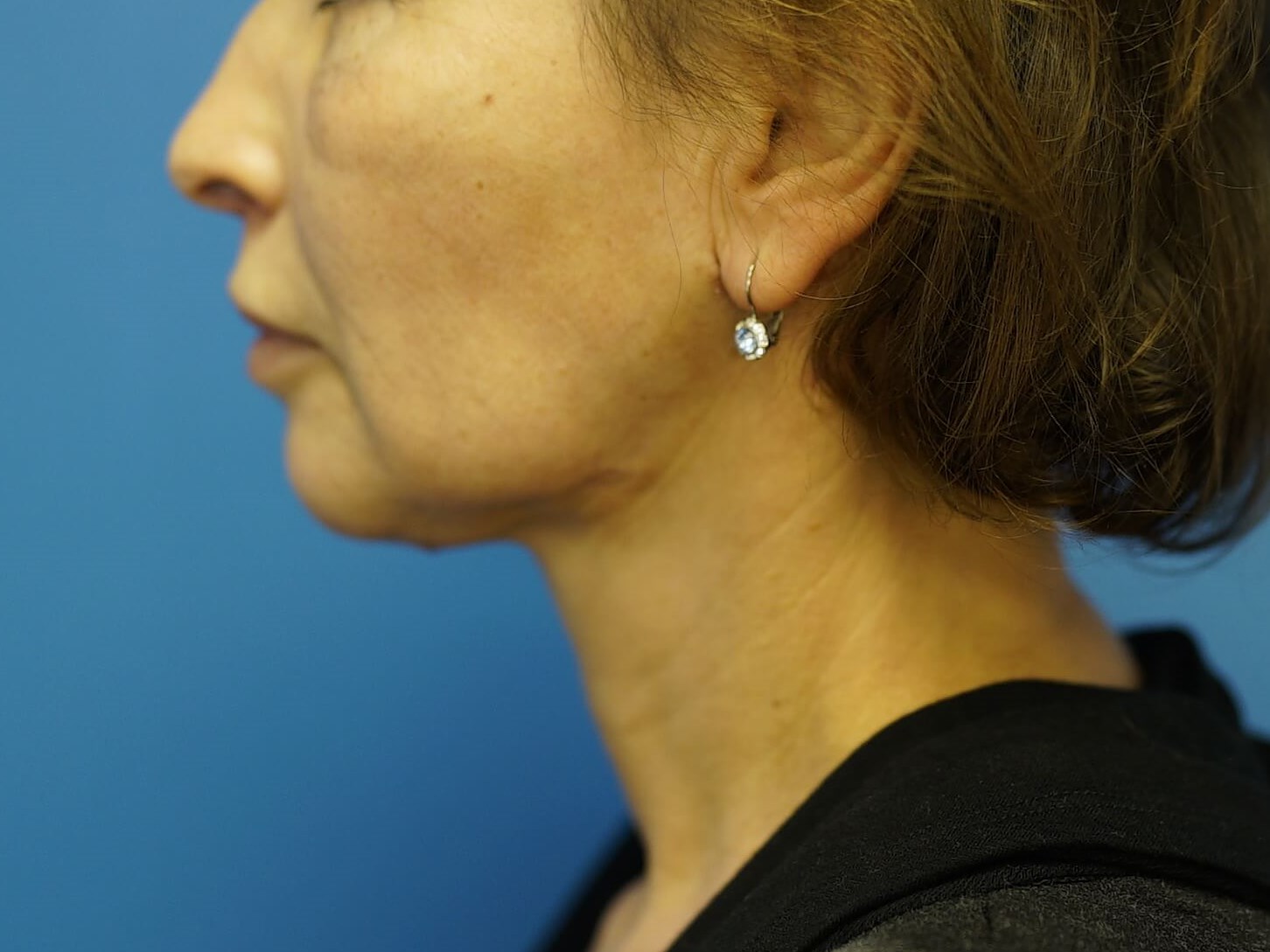 Woman has Neck Lift, Fat Graft After