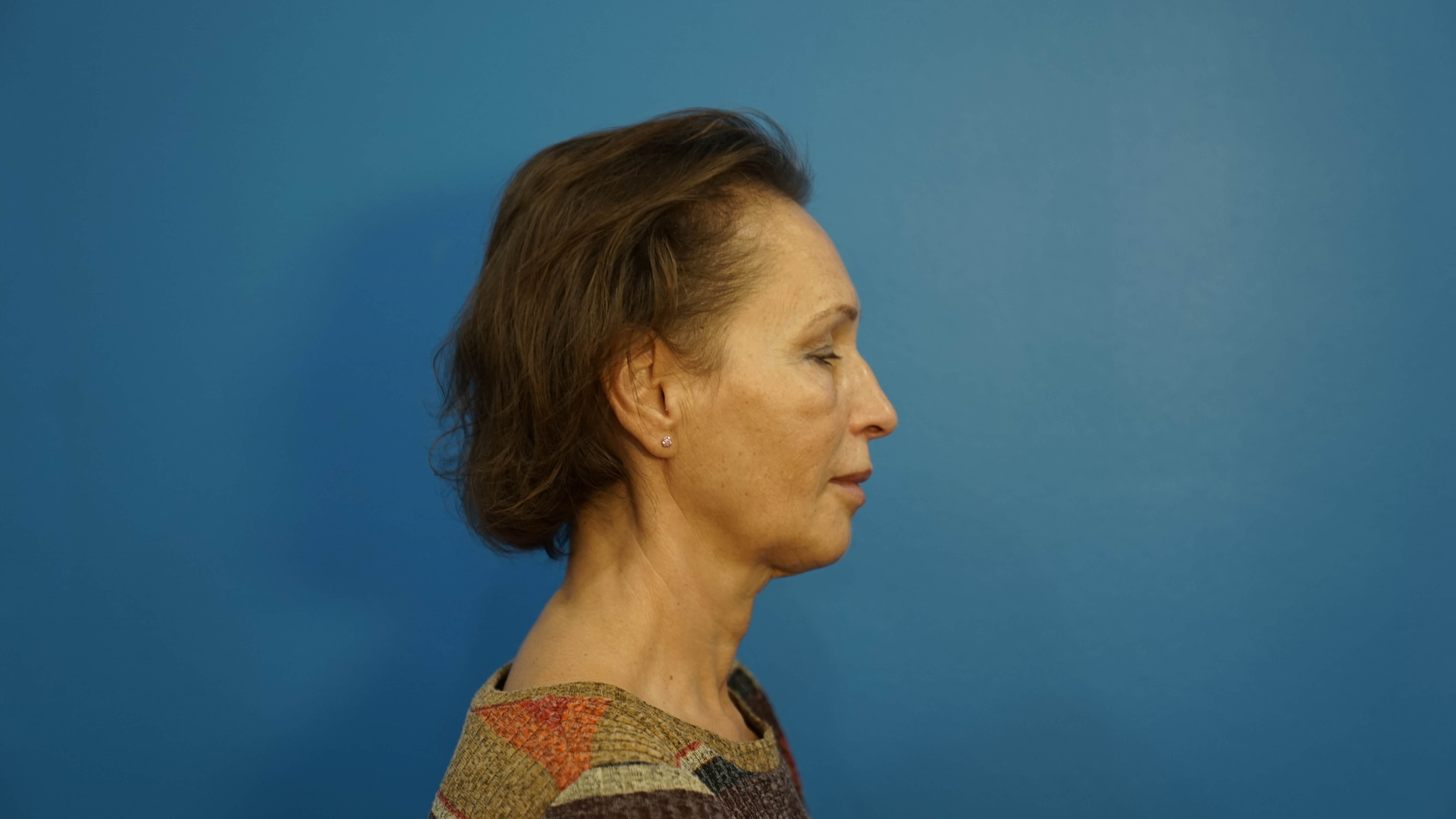 Woman has Neck Lift, Fat Graft Before