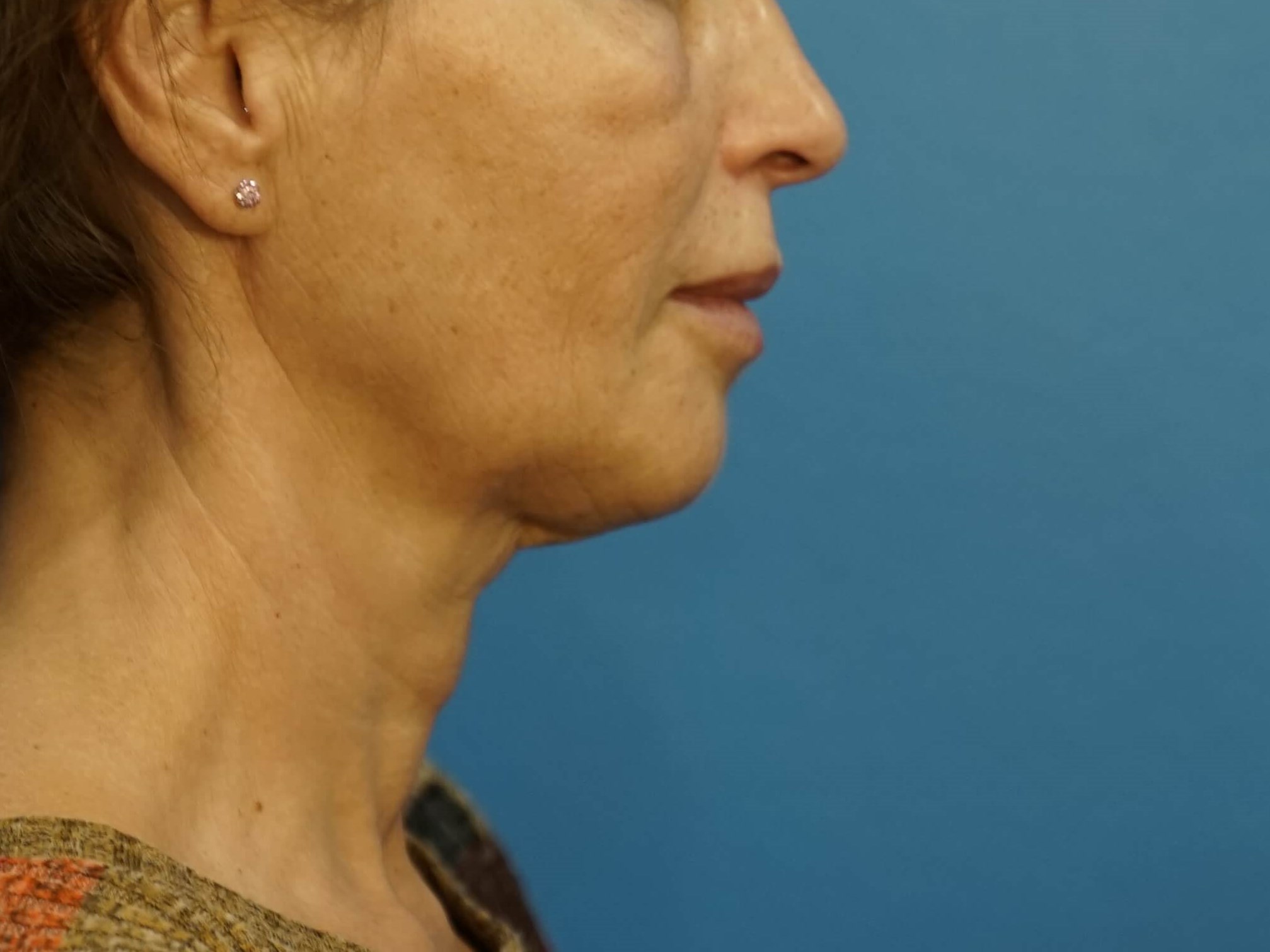 Woman has Neck Lift, Fat Graft Before