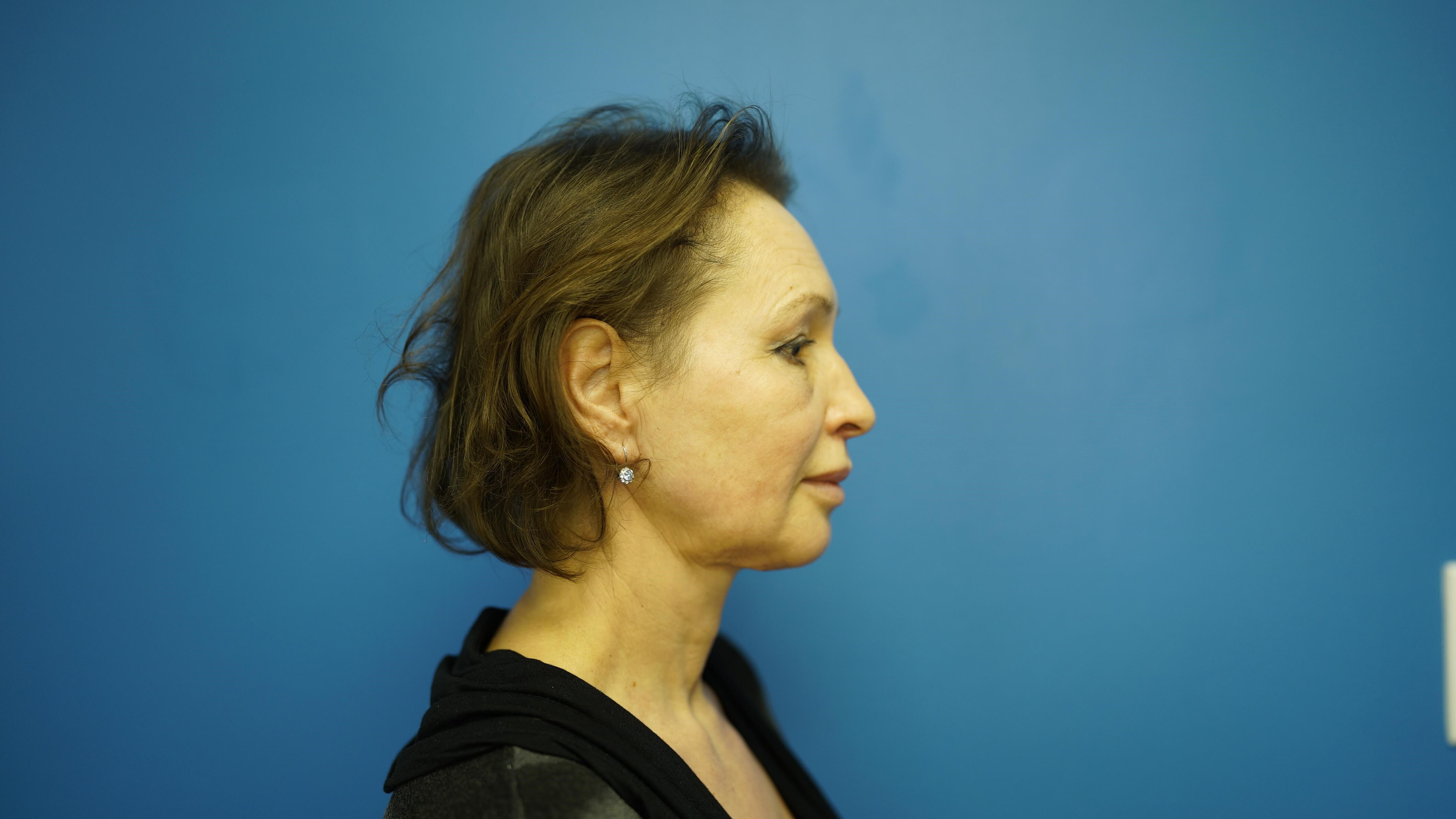 Woman has Neck Lift, Fat Graft After