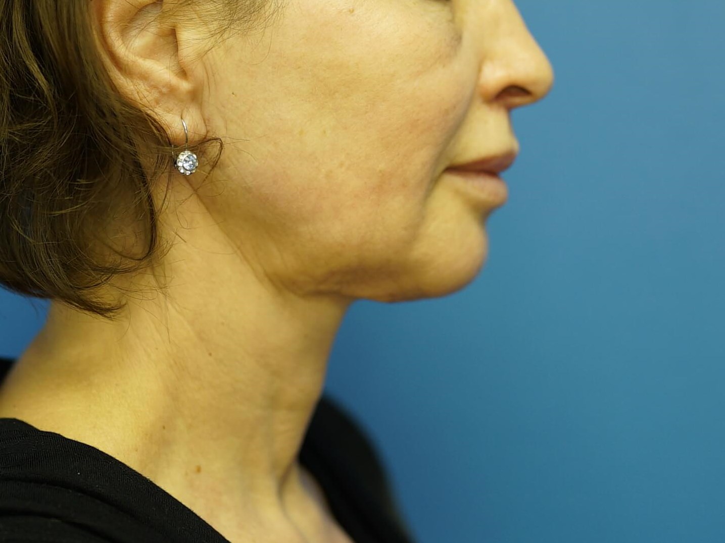 Woman has Neck Lift, Fat Graft After