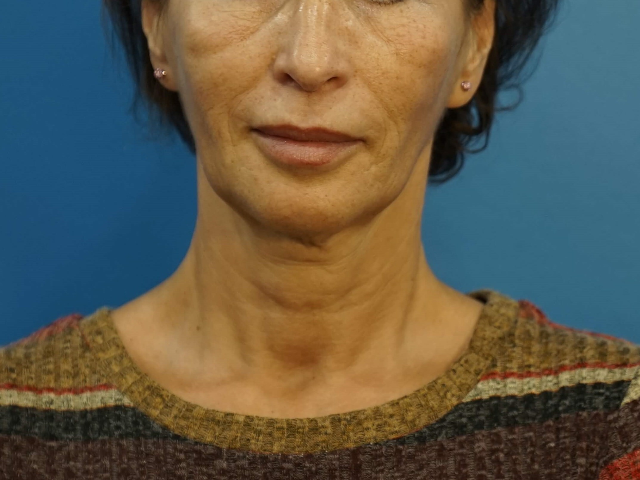 Woman has Neck Lift, Fat Graft Before