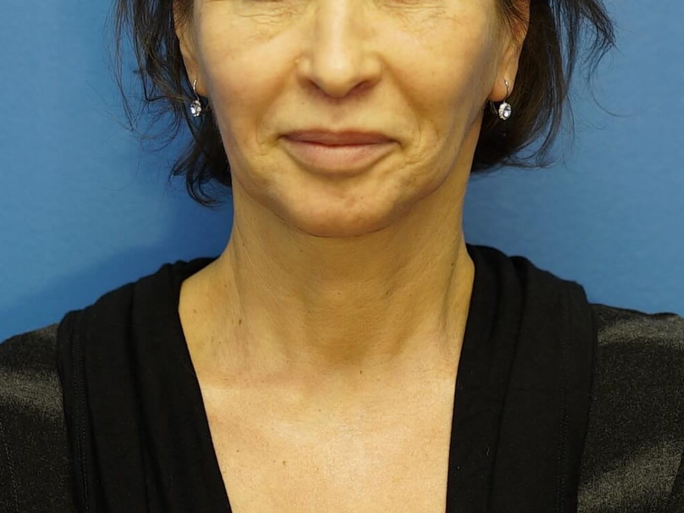 Woman has Neck Lift, Fat Graft After