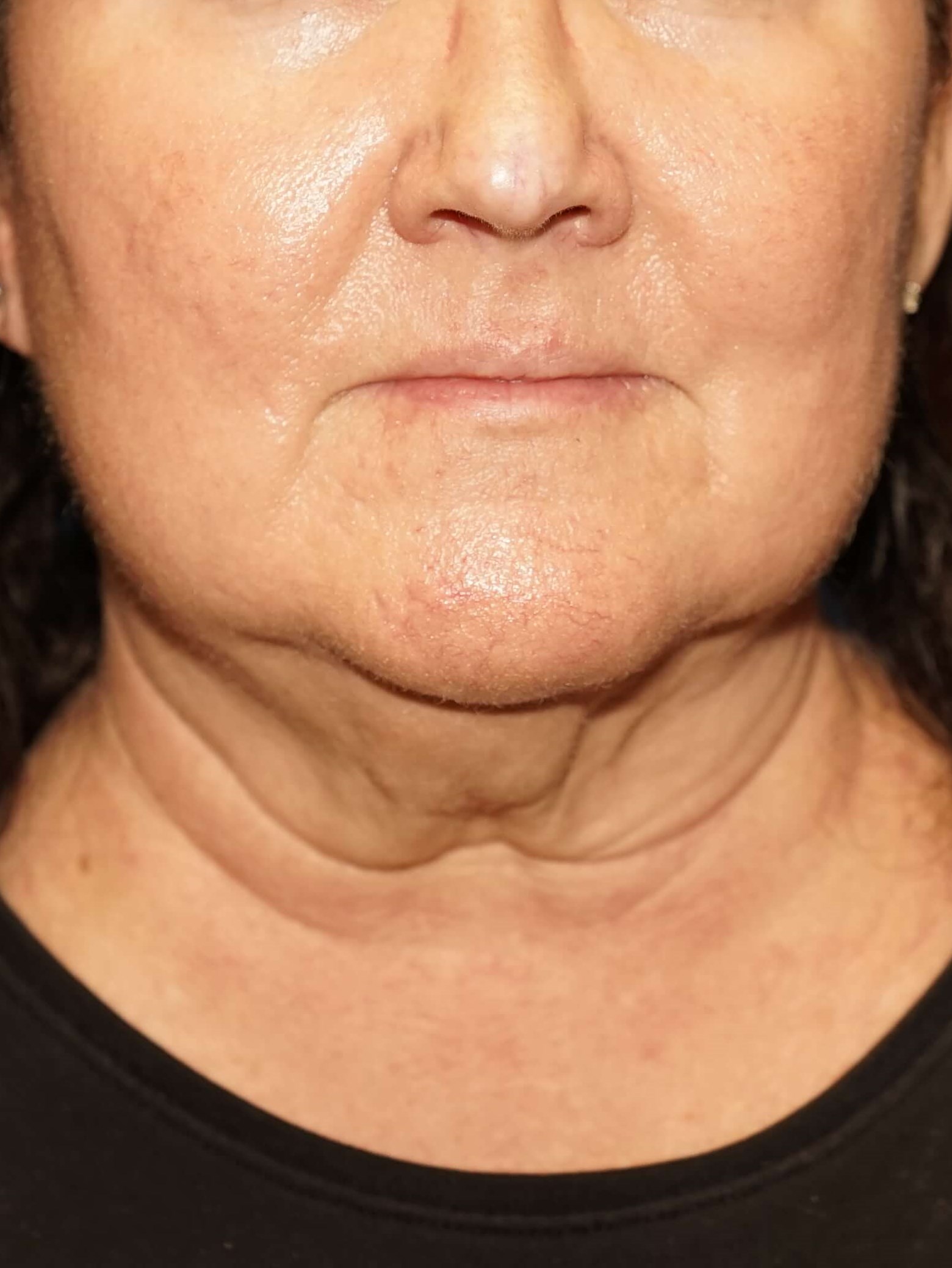 Woman has Neck Lift Before