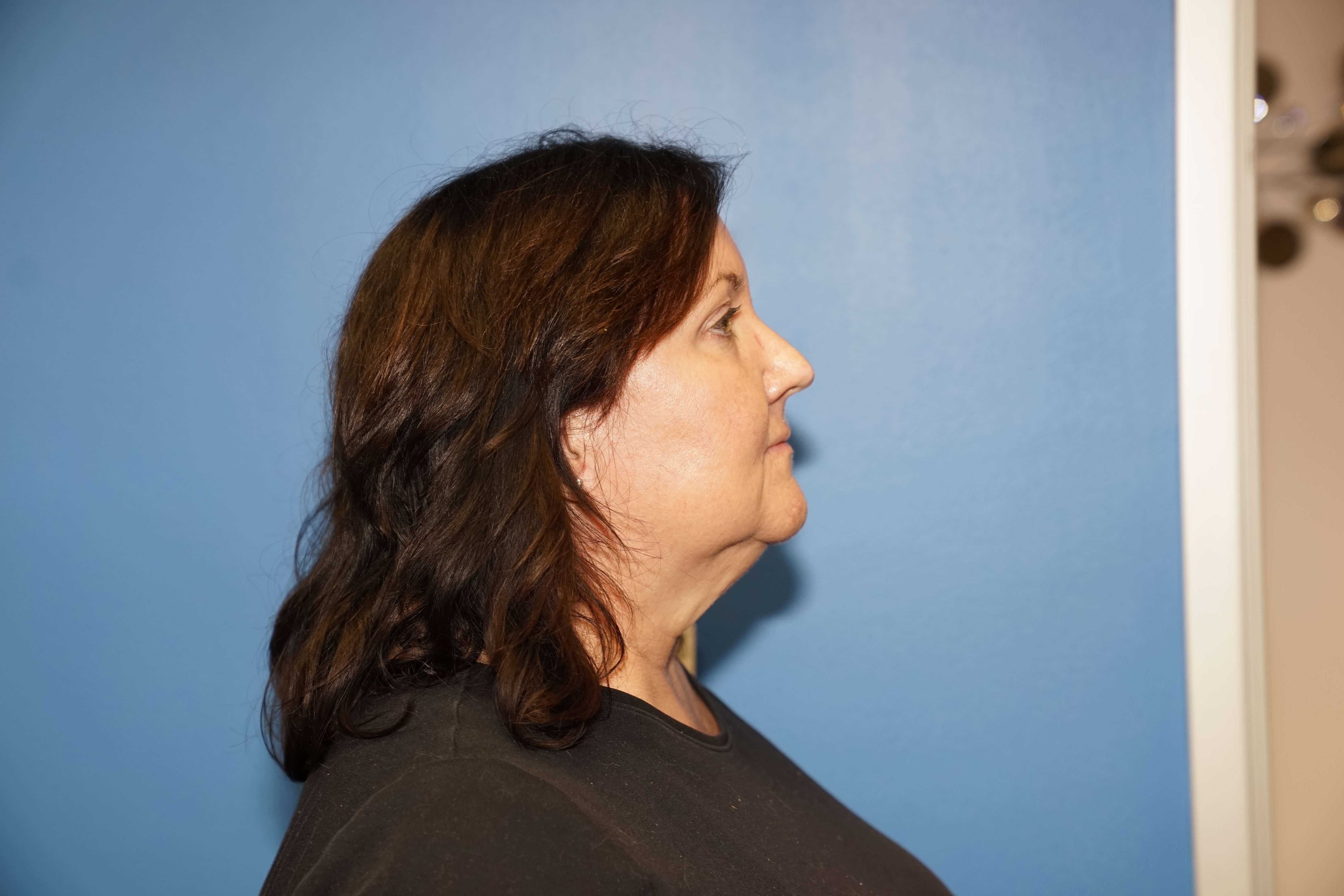Woman has Neck Lift Before