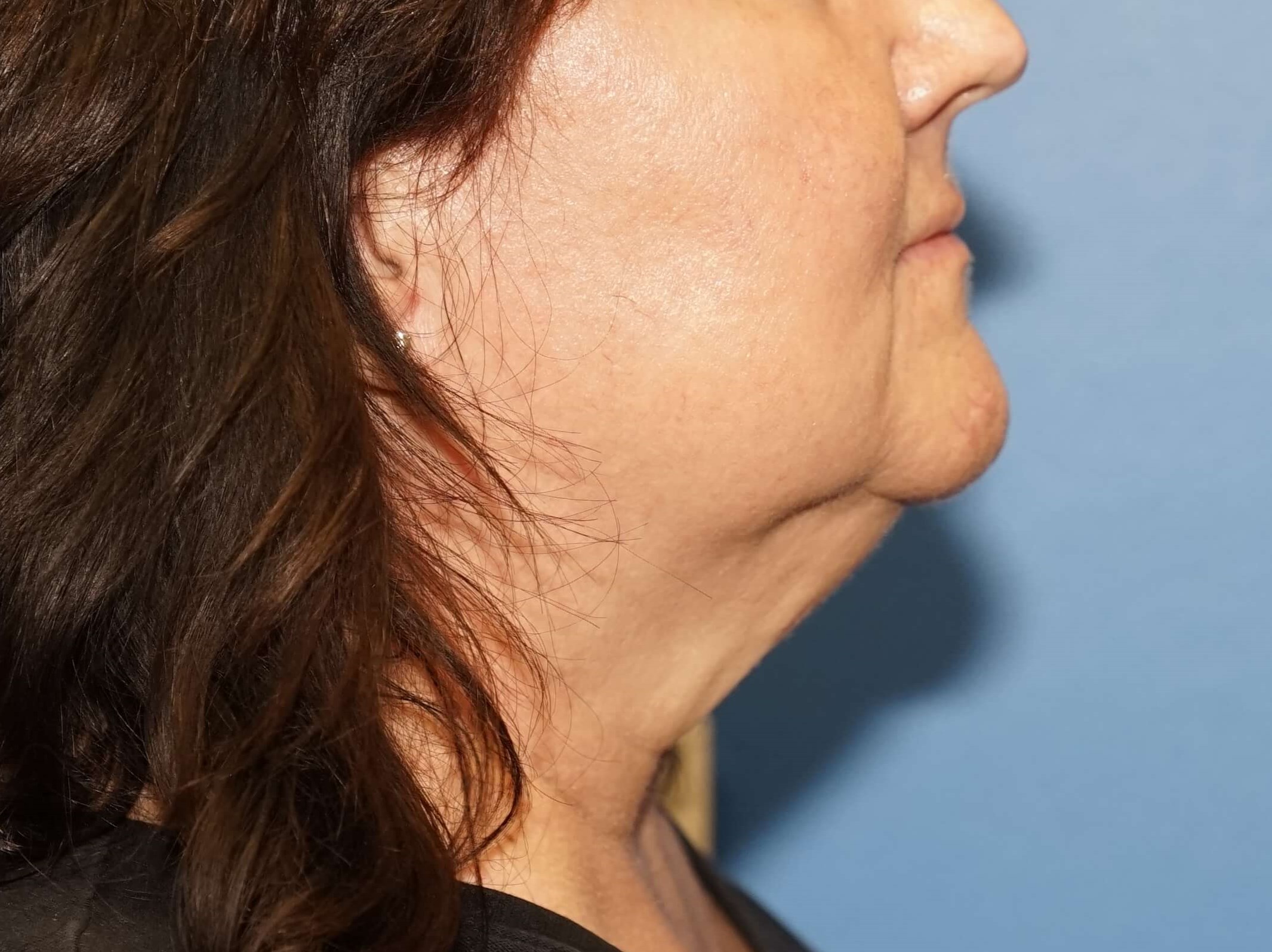 Woman has Neck Lift Before