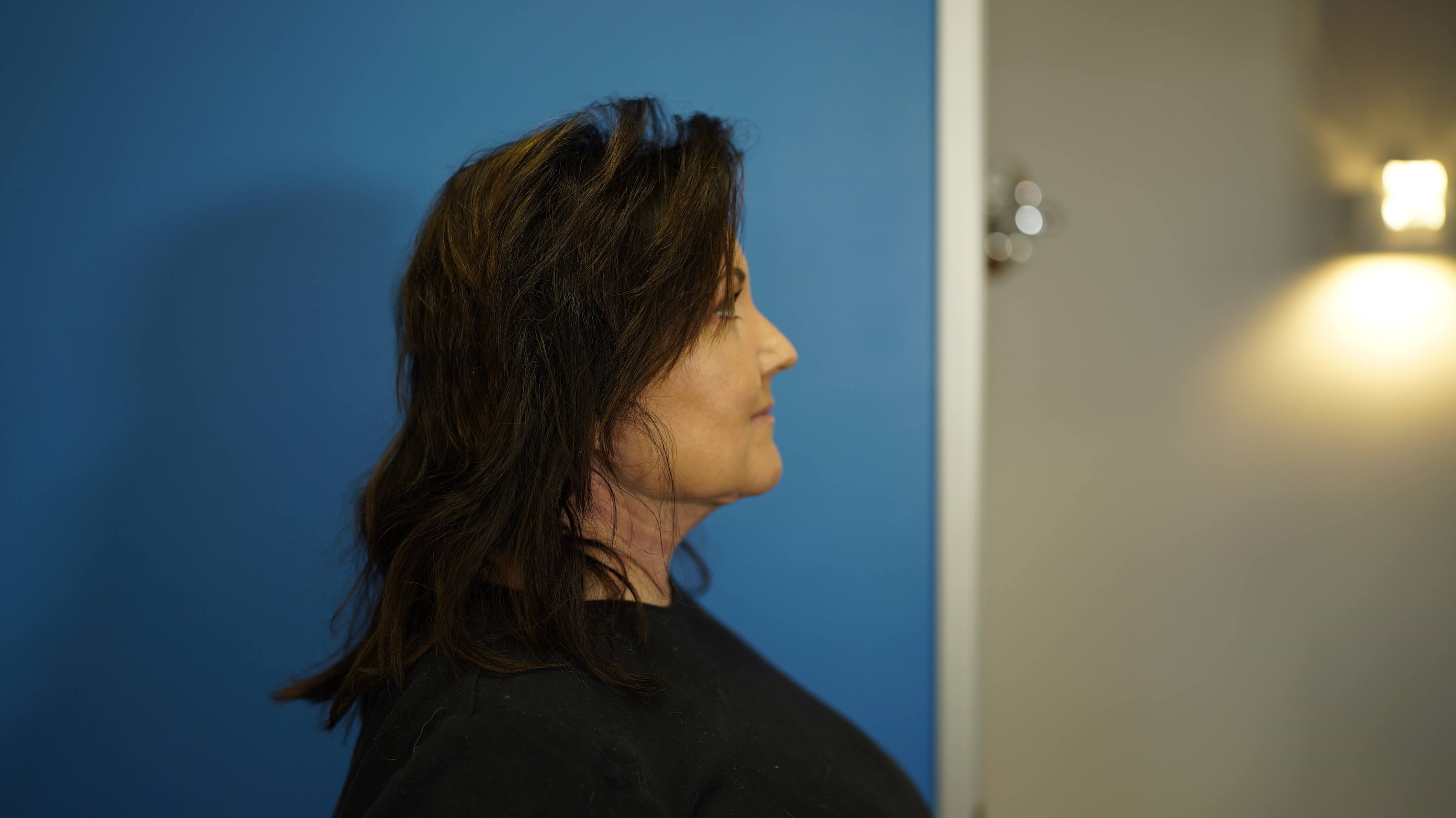 Woman has Neck Lift After