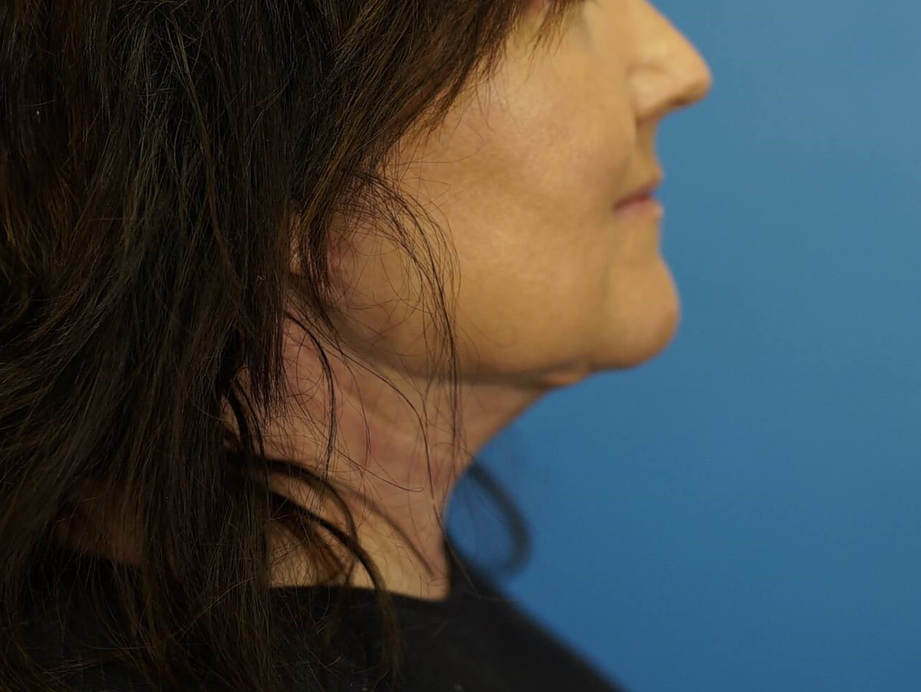 Woman has Neck Lift After