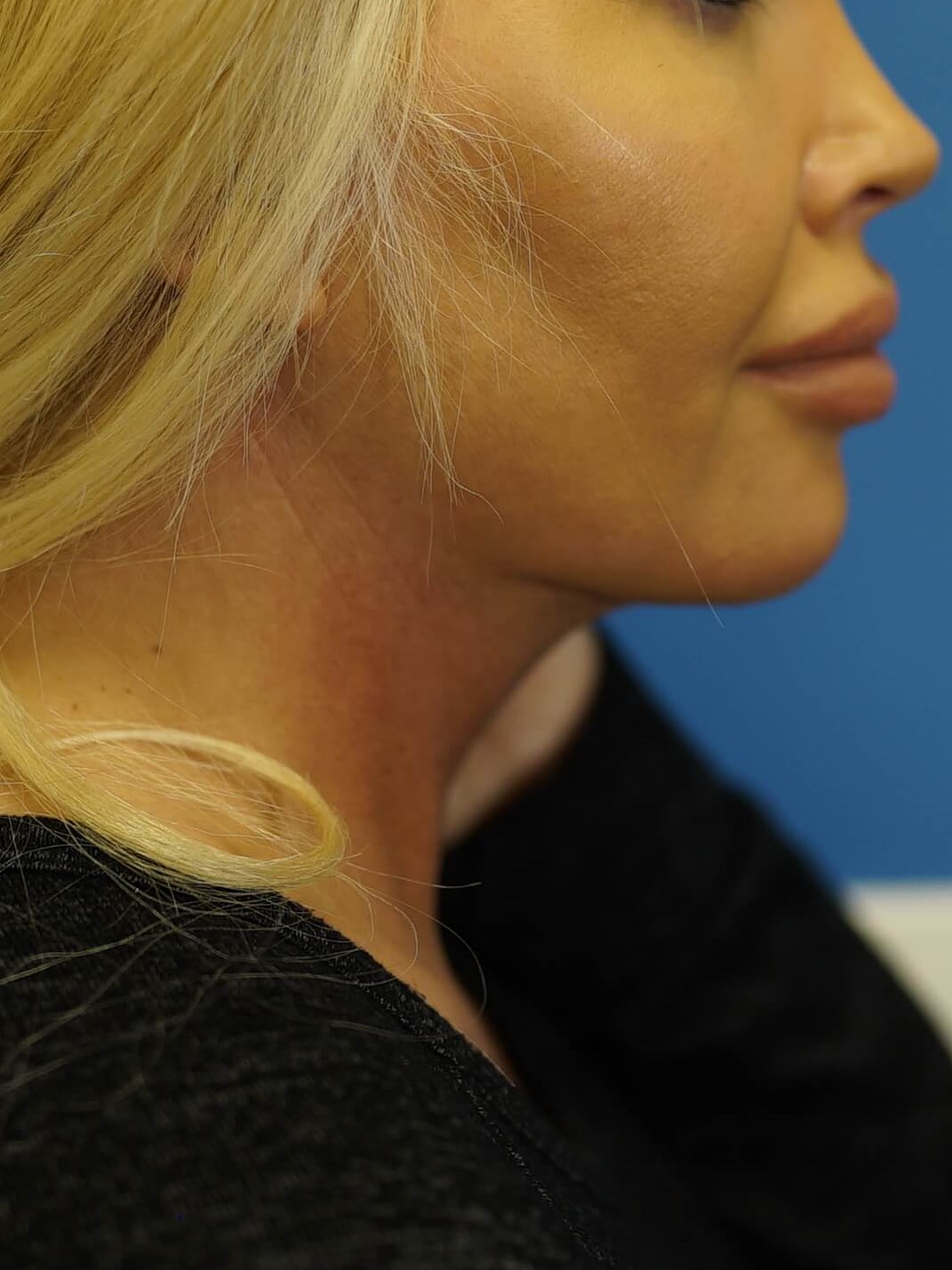 Woman has Neck Liposuction After