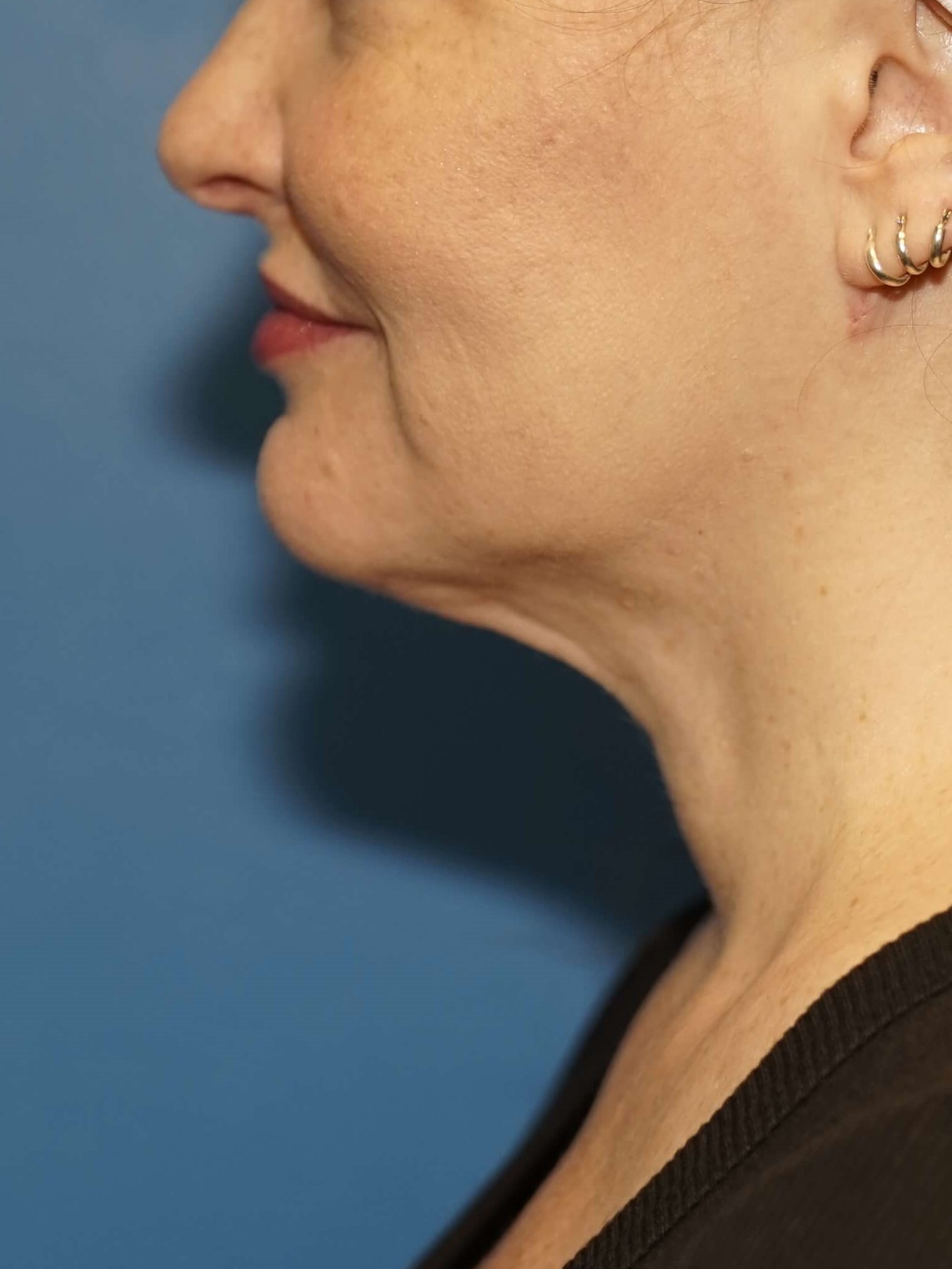 Woman has Neck Liposuction After