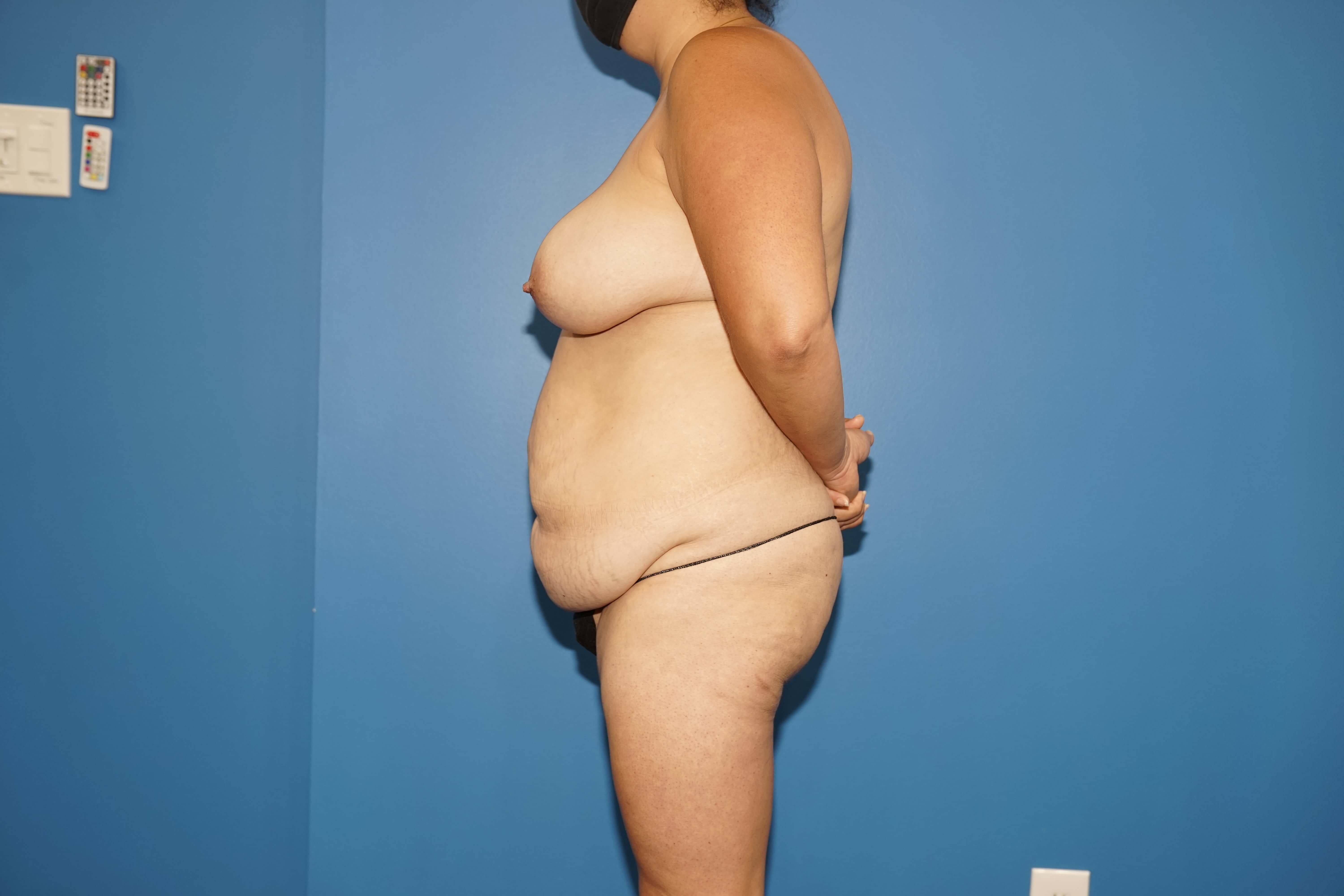 Woman has Mommy Makeover Before