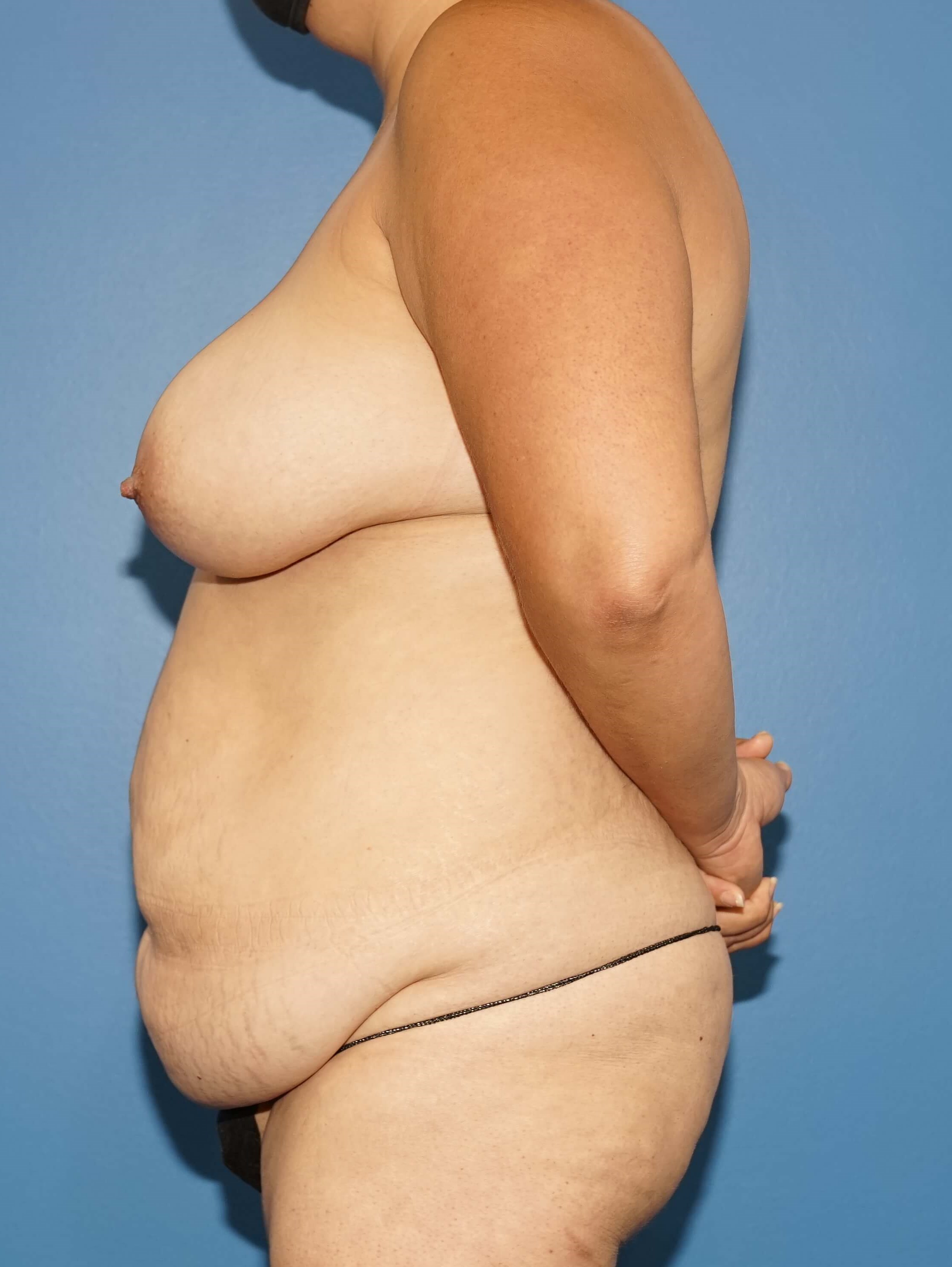 Woman has Mommy Makeover Before