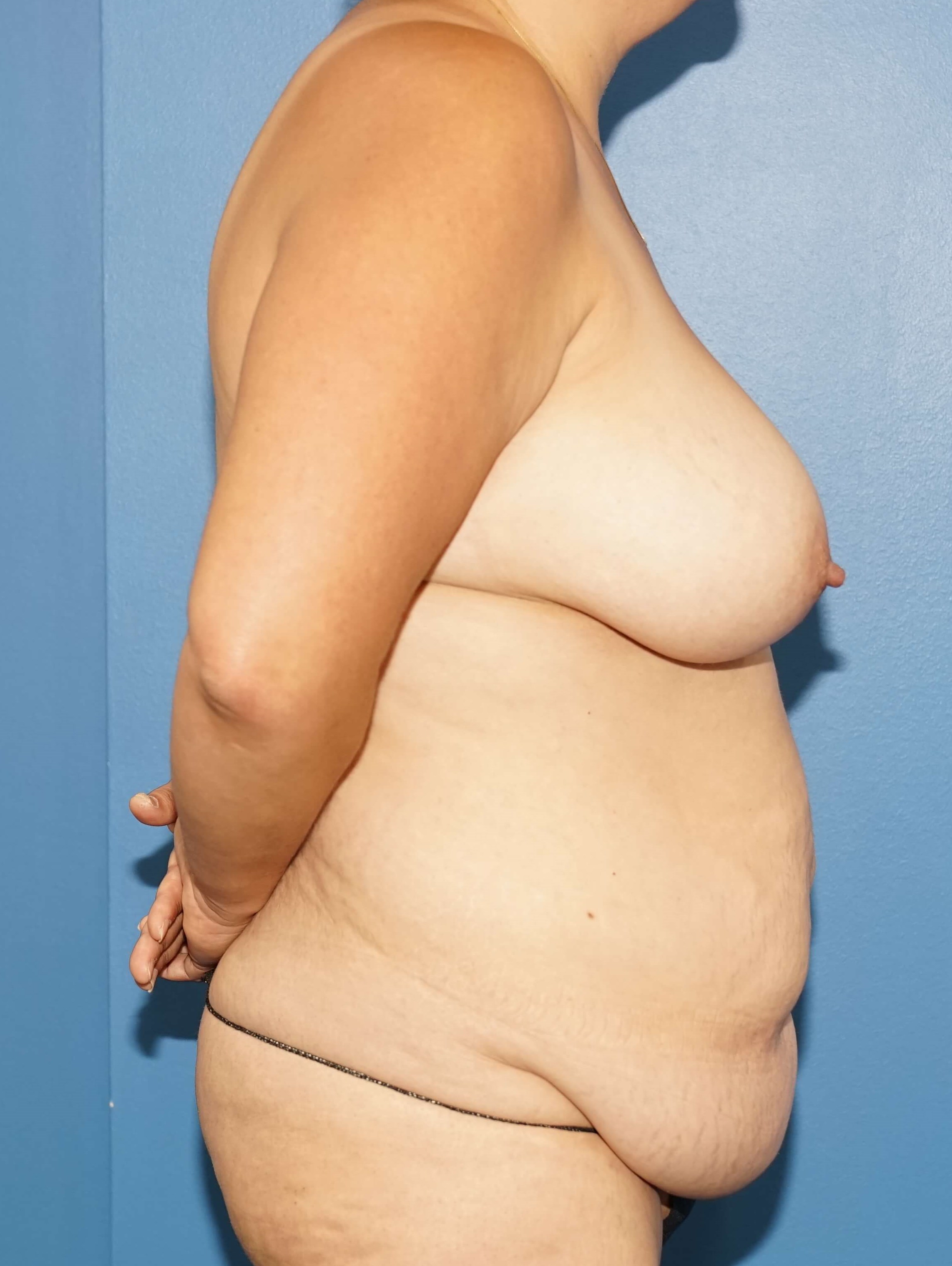 Woman has Mommy Makeover Before