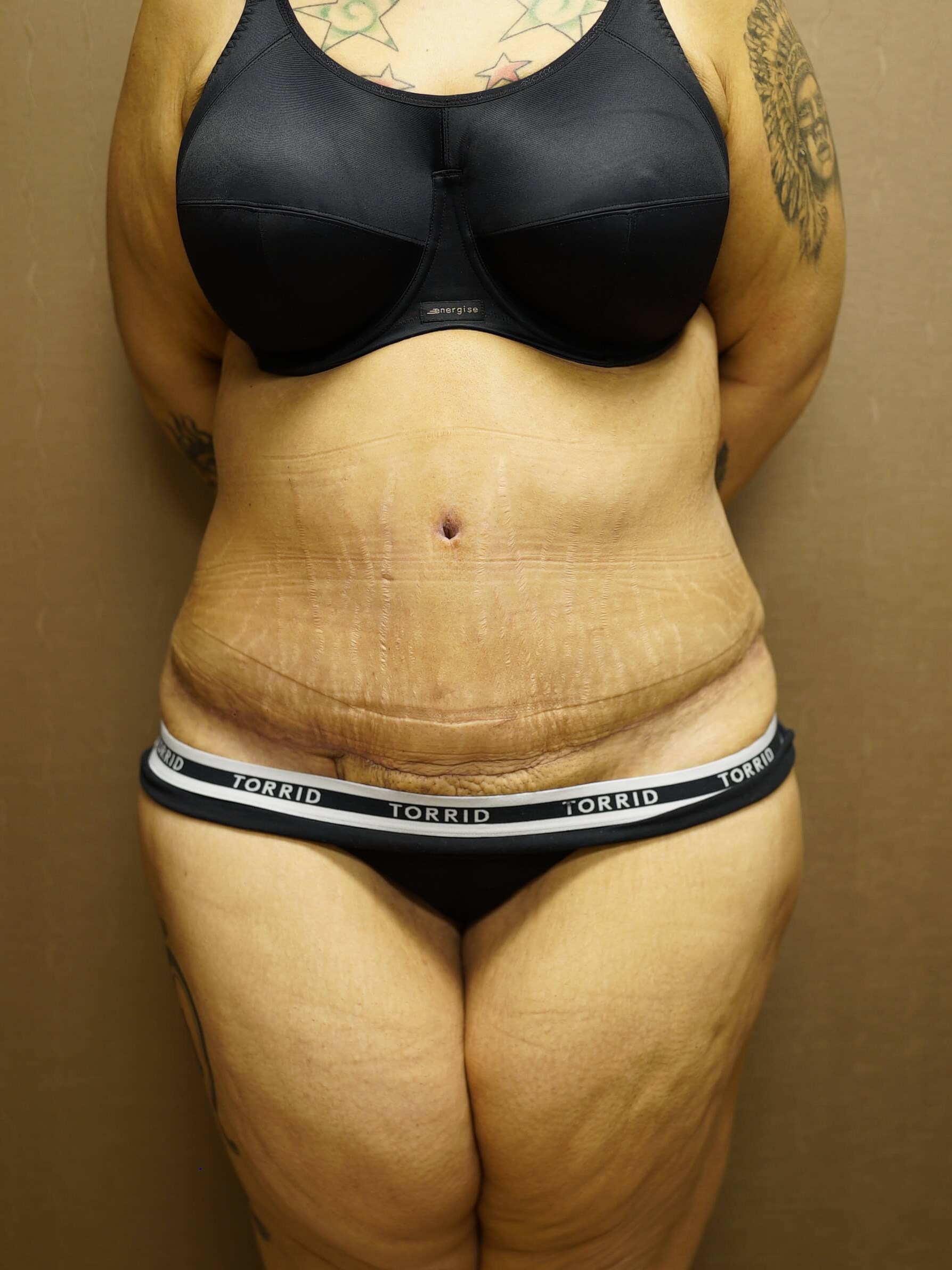Woman Has Tummy Tuck After