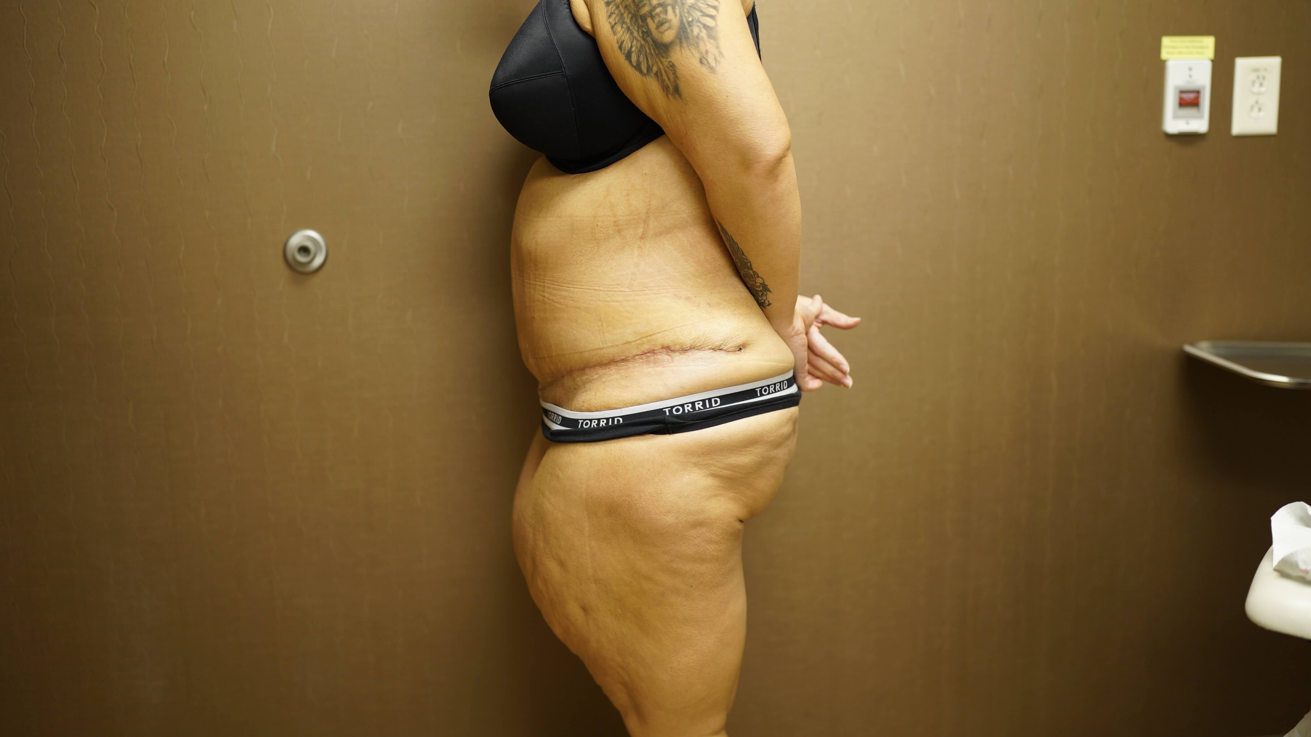 Woman Has Tummy Tuck After