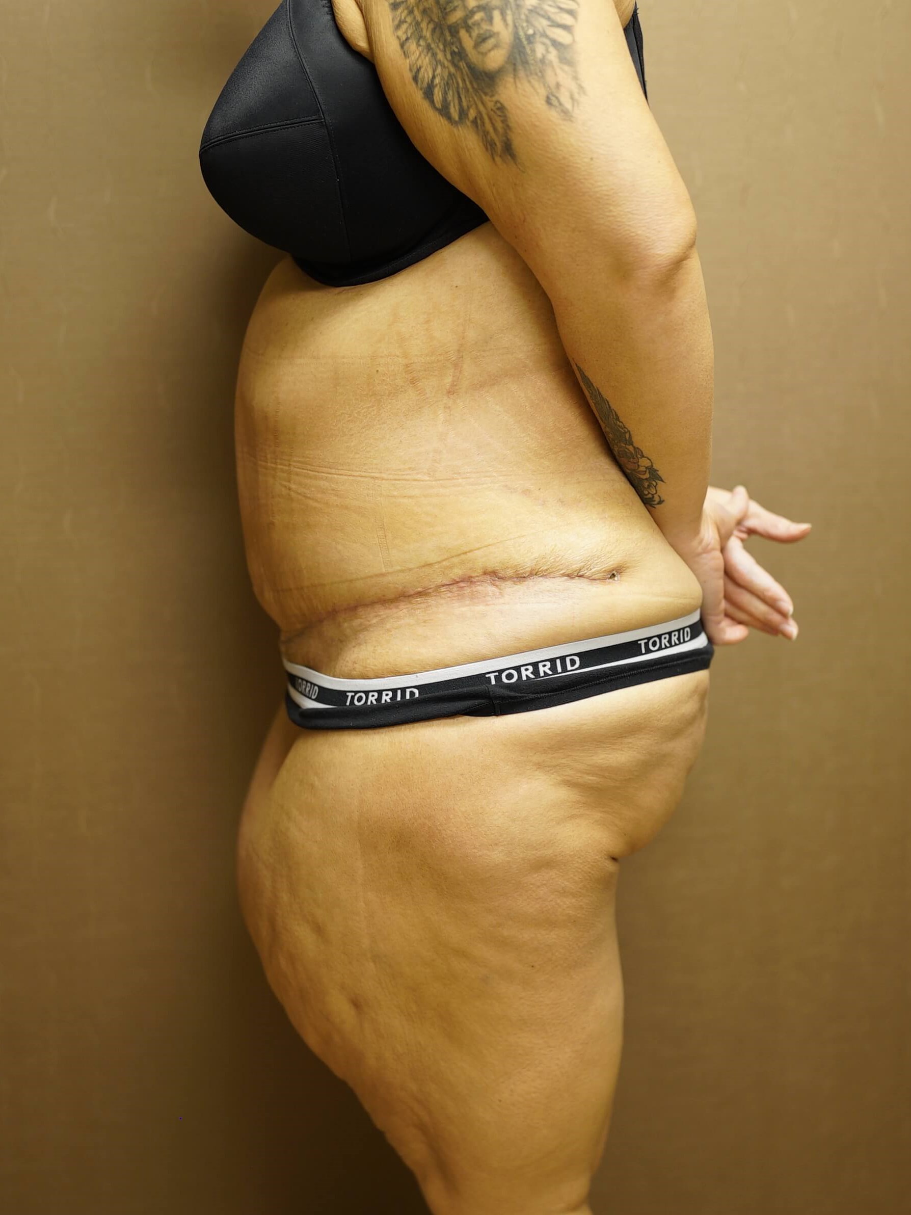 Woman Has Tummy Tuck After