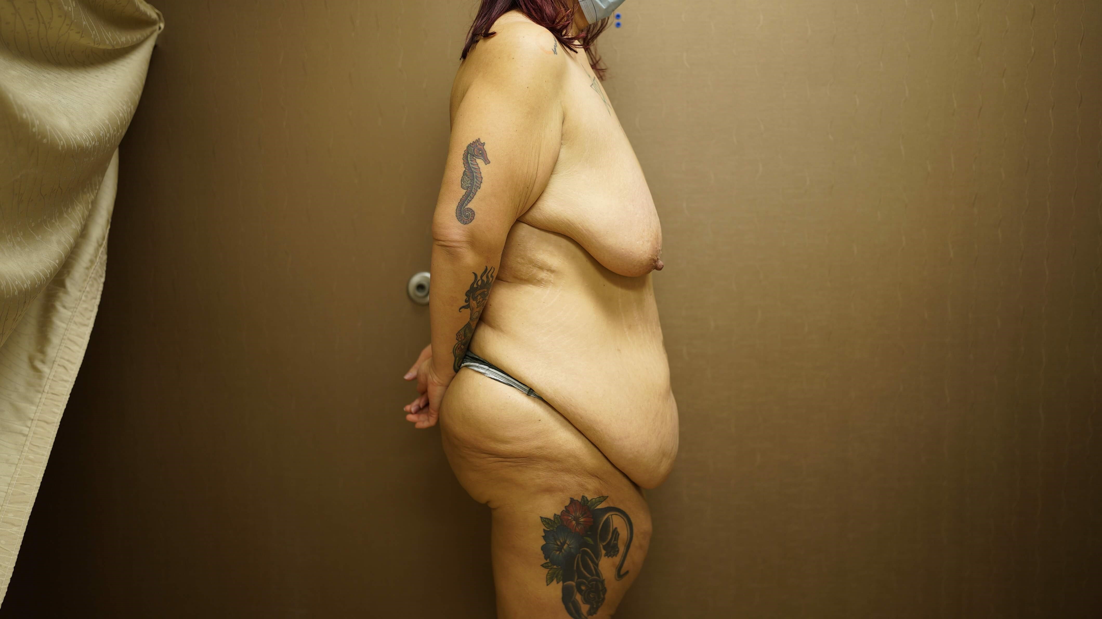 Woman Has Tummy Tuck Before