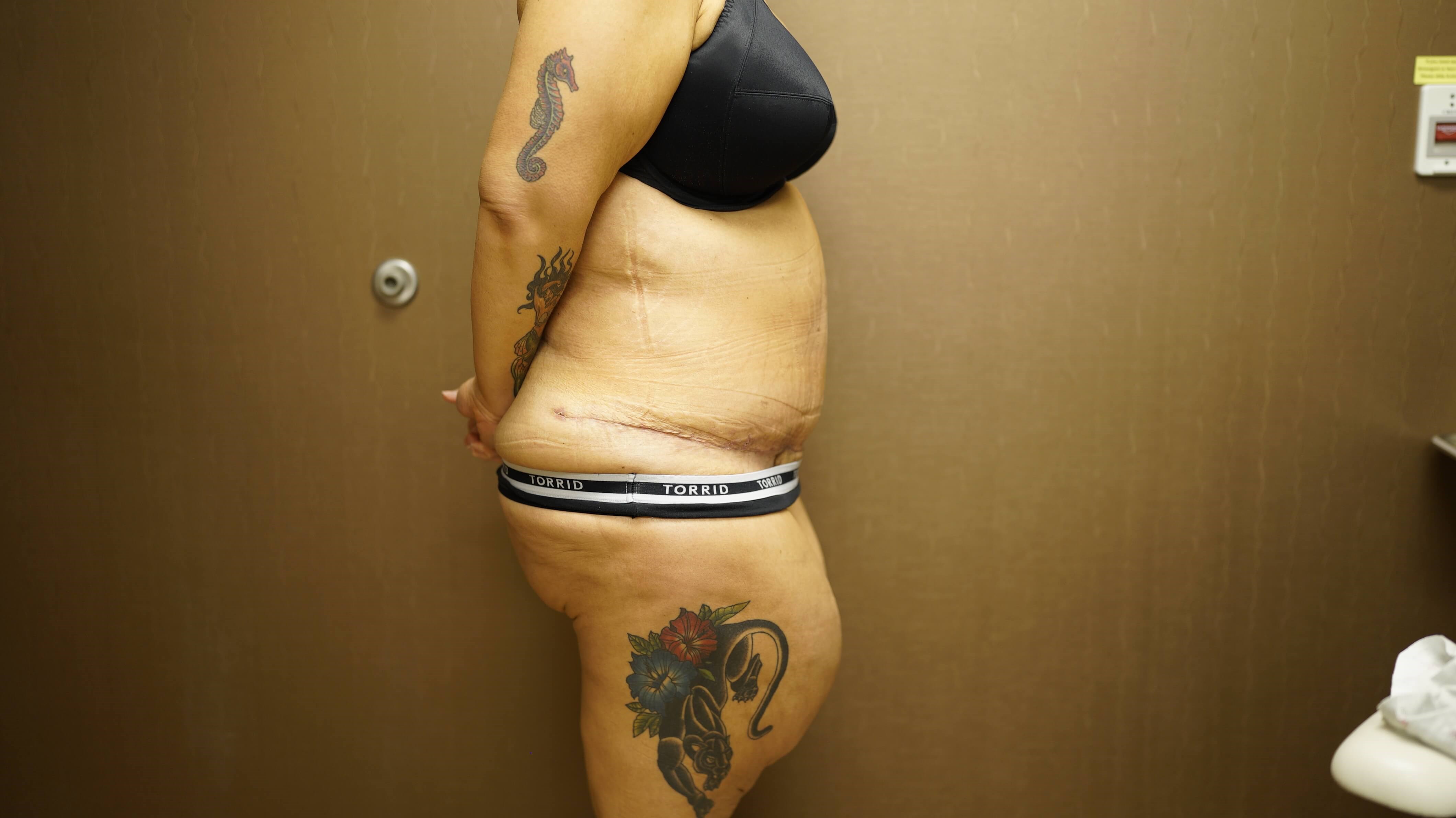 Woman Has Tummy Tuck After