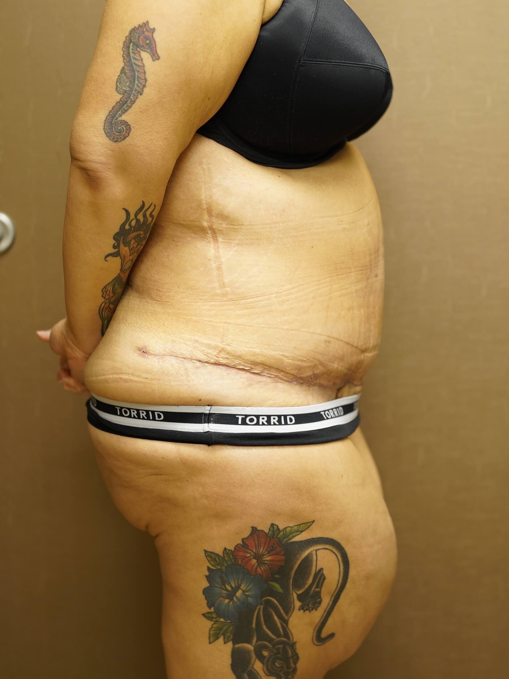 Woman Has Tummy Tuck After
