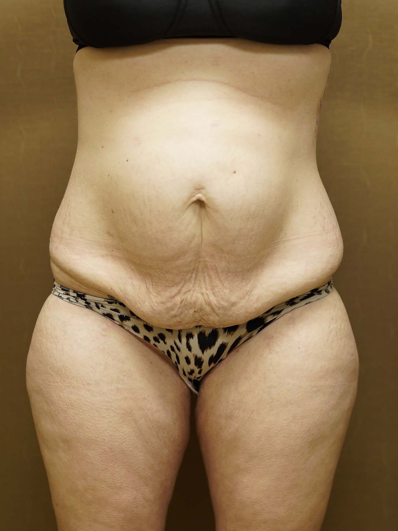 Woman Has Tummy Tuck Lipo Before