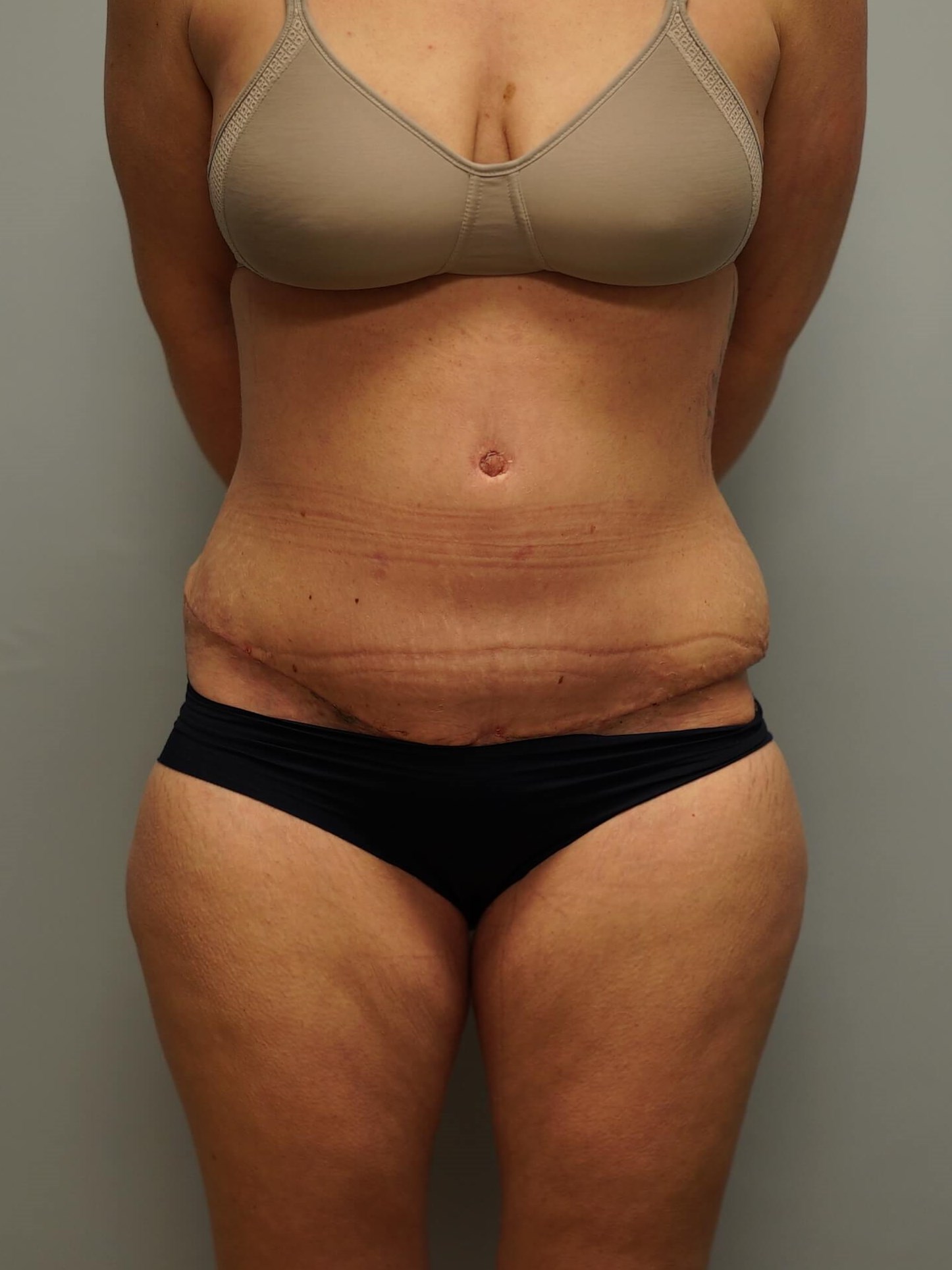 Woman Has Tummy Tuck Lipo After