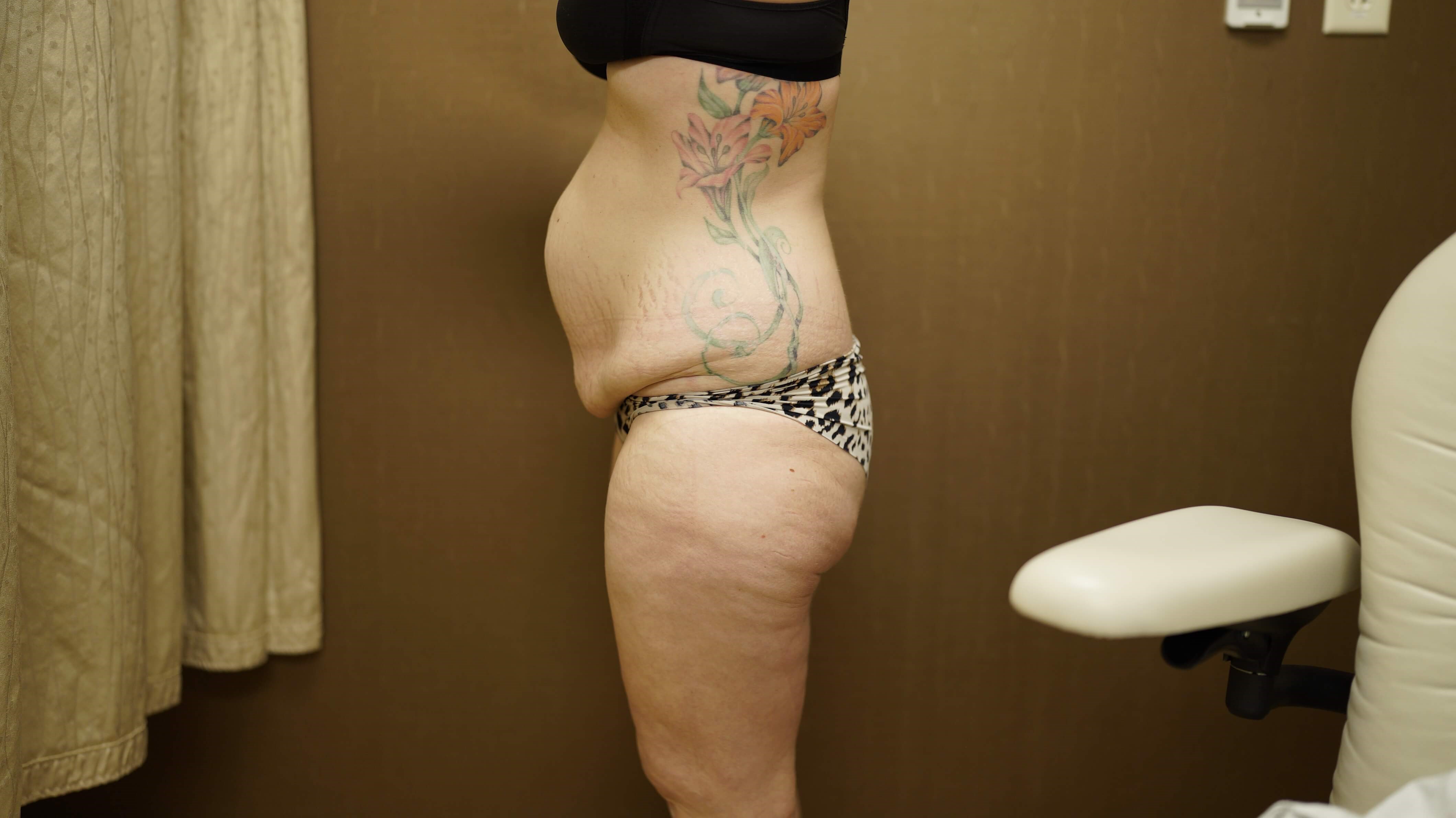 Woman Has Tummy Tuck Lipo Before