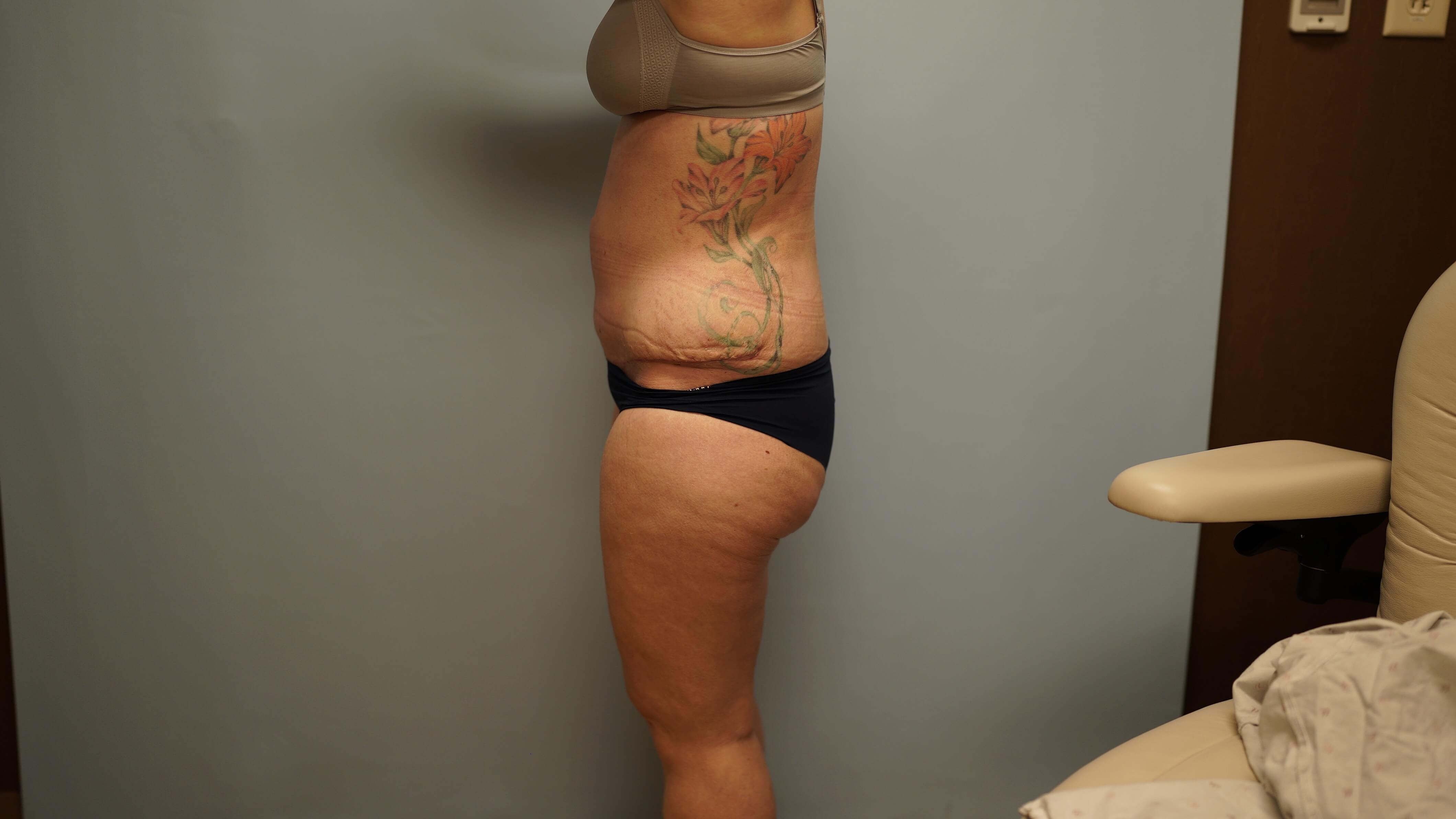 Woman Has Tummy Tuck Lipo After