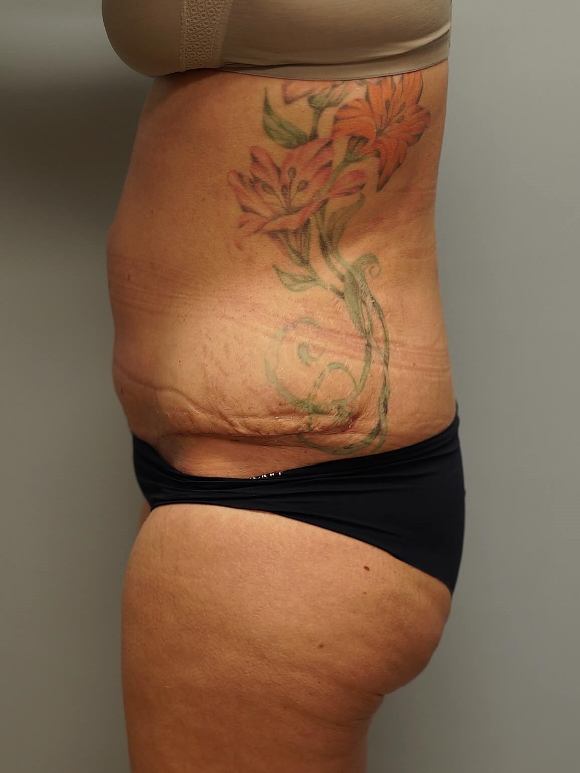 Woman Has Tummy Tuck Lipo After