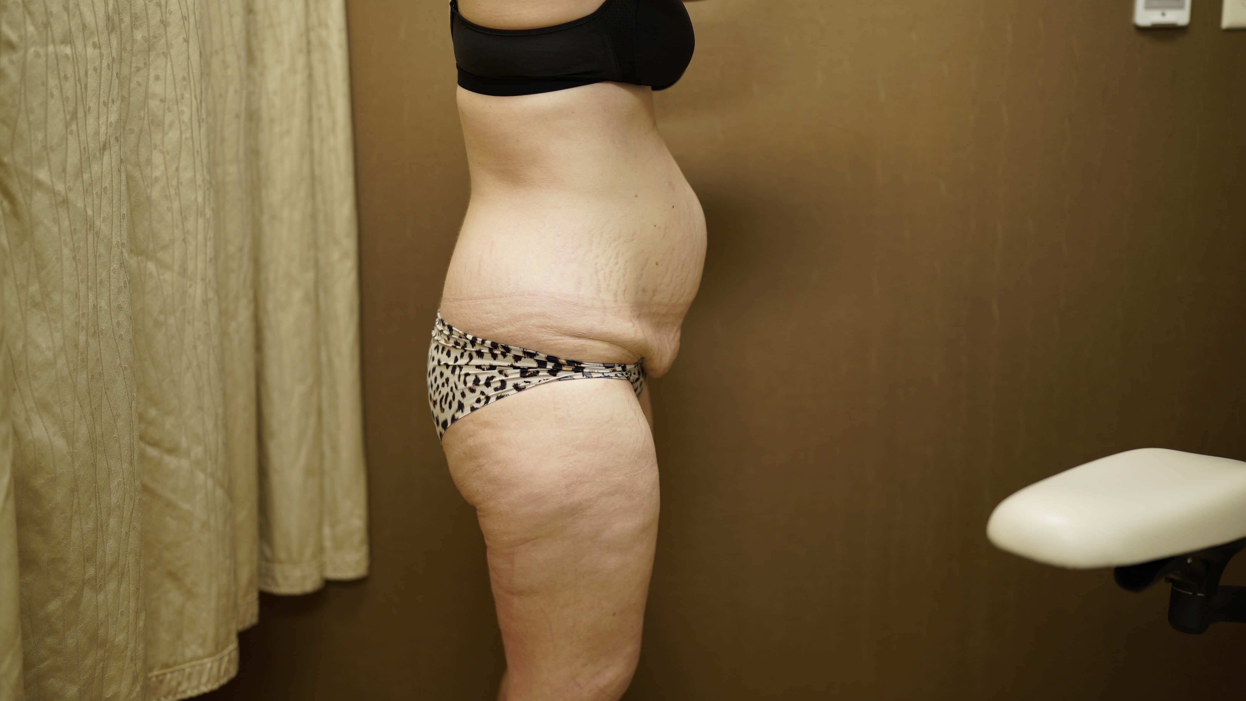 Woman Has Tummy Tuck Lipo Before
