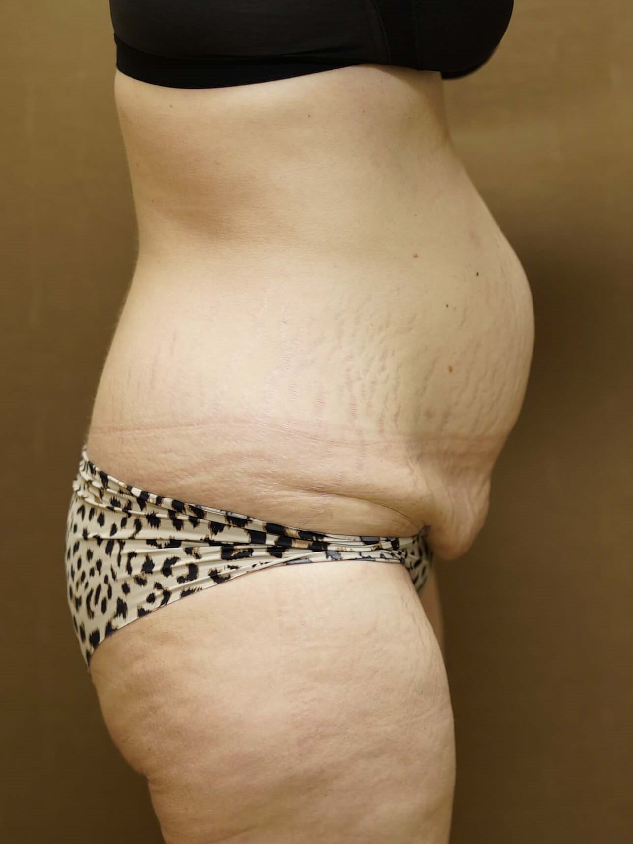 Woman Has Tummy Tuck Lipo Before