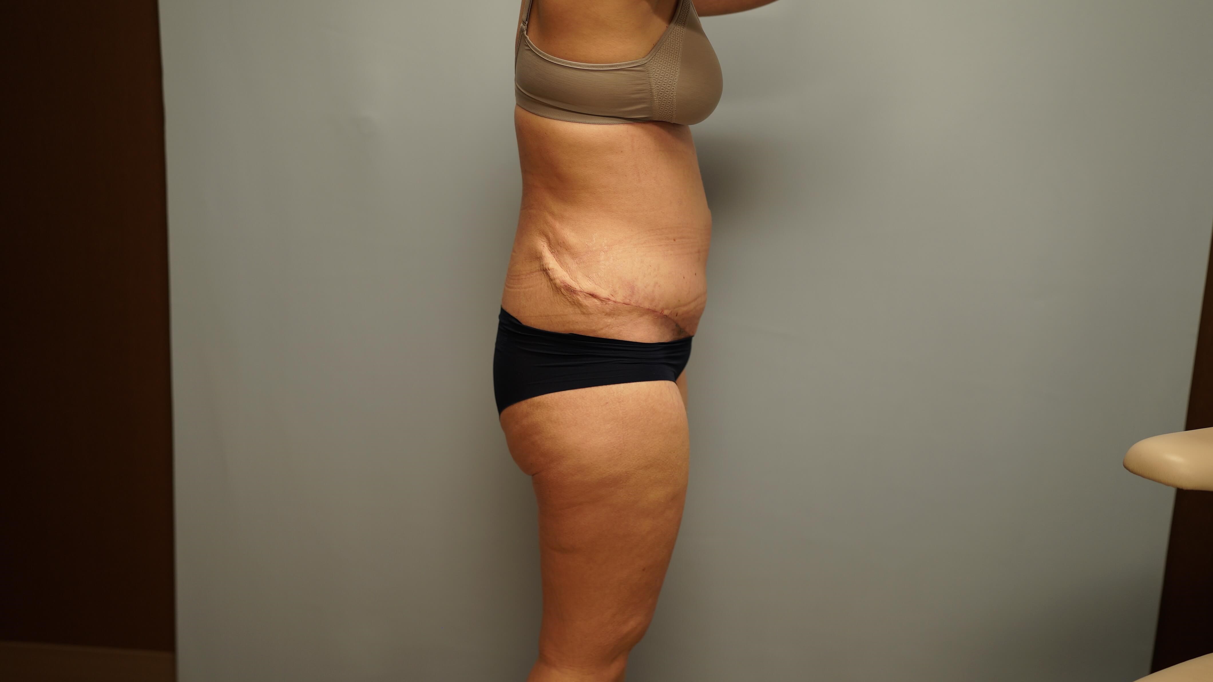 Woman Has Tummy Tuck Lipo After