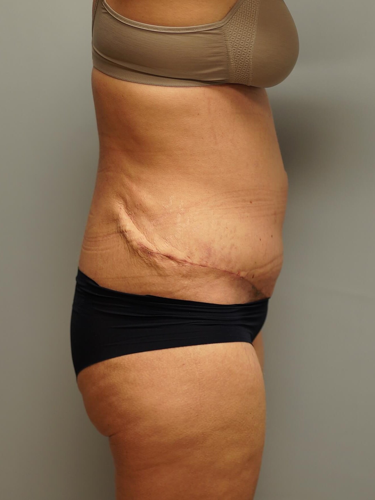 Woman Has Tummy Tuck Lipo After