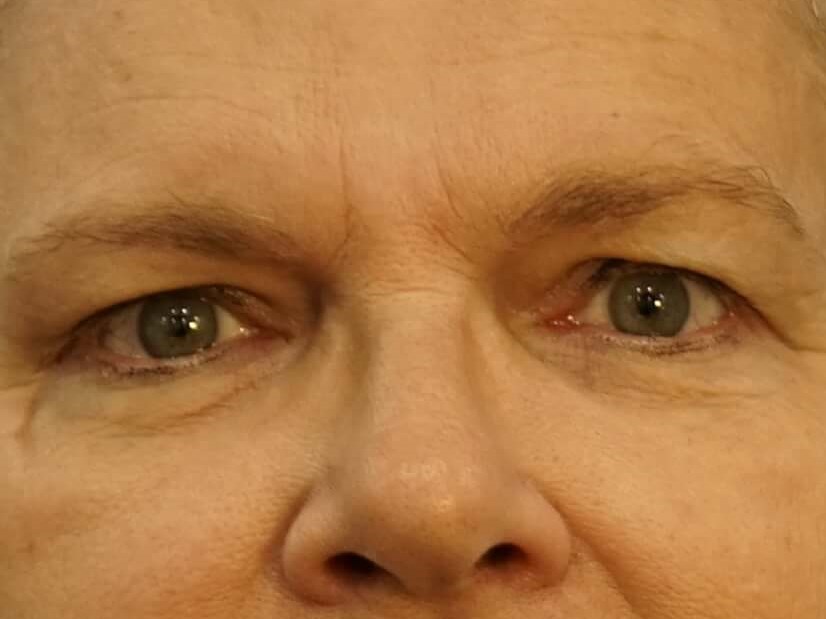Woman has Upper Eyelid Lift Before
