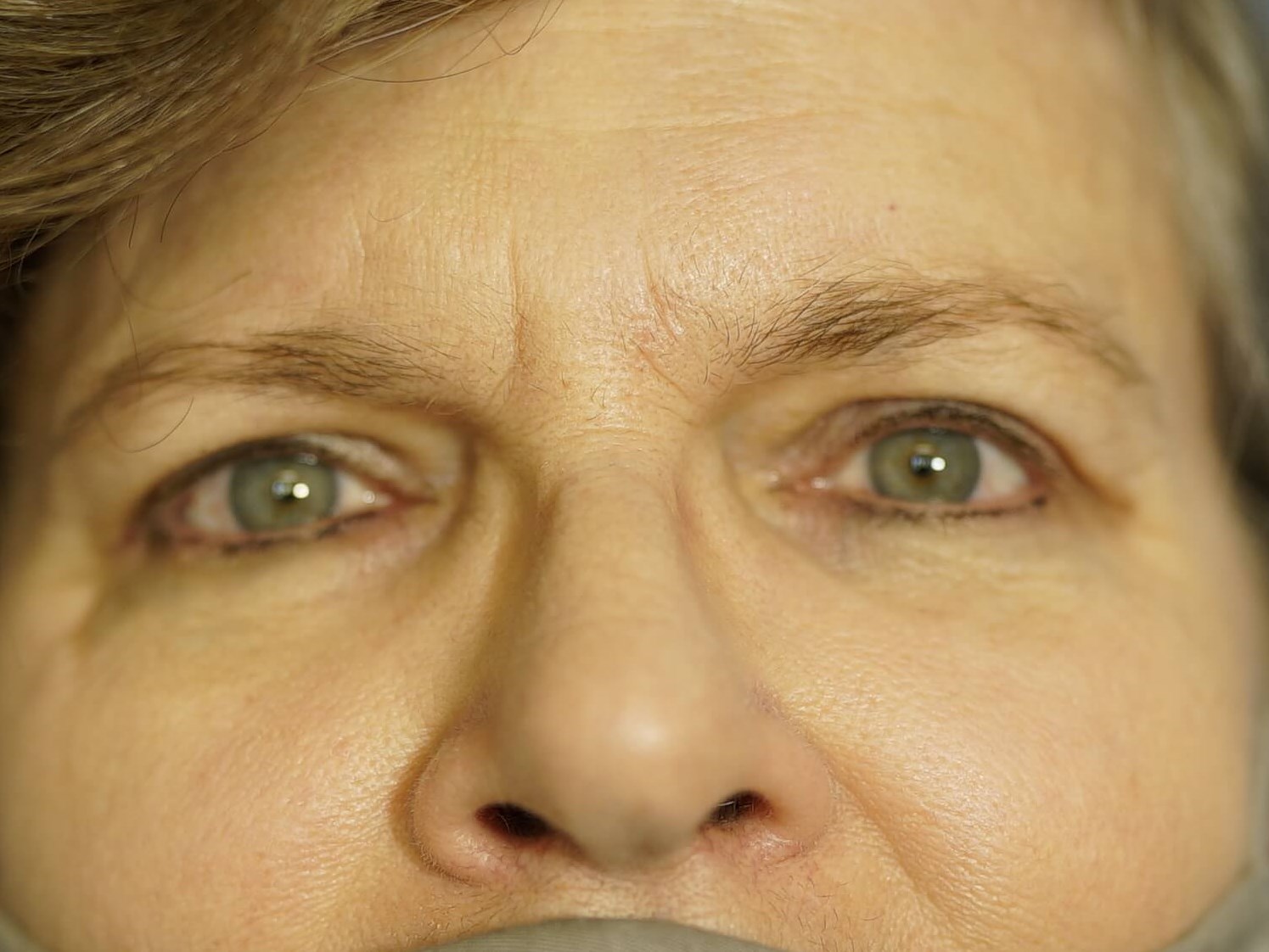 Woman has Upper Eyelid Lift After