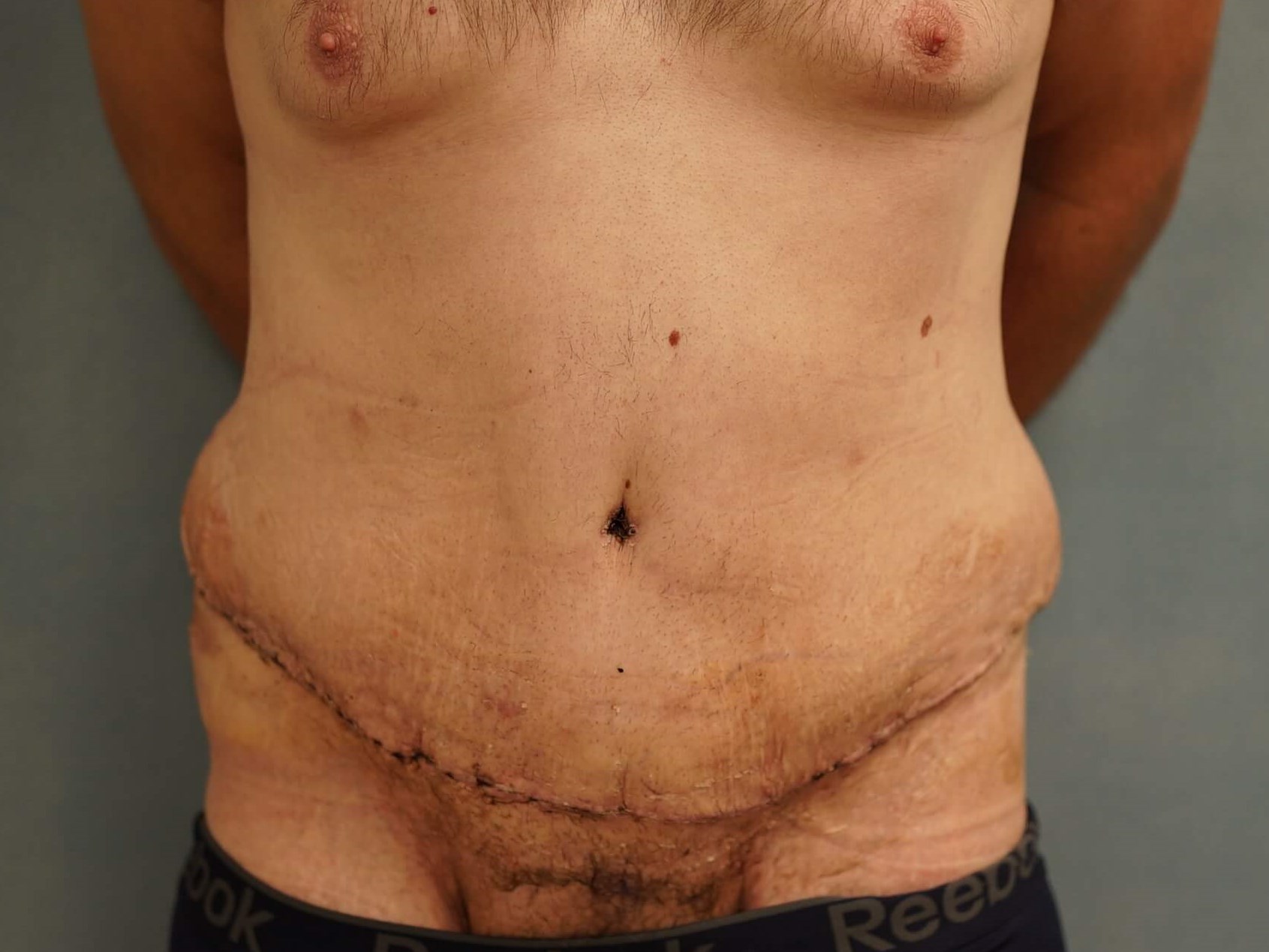 Tummy Tuck post Bariatric After
