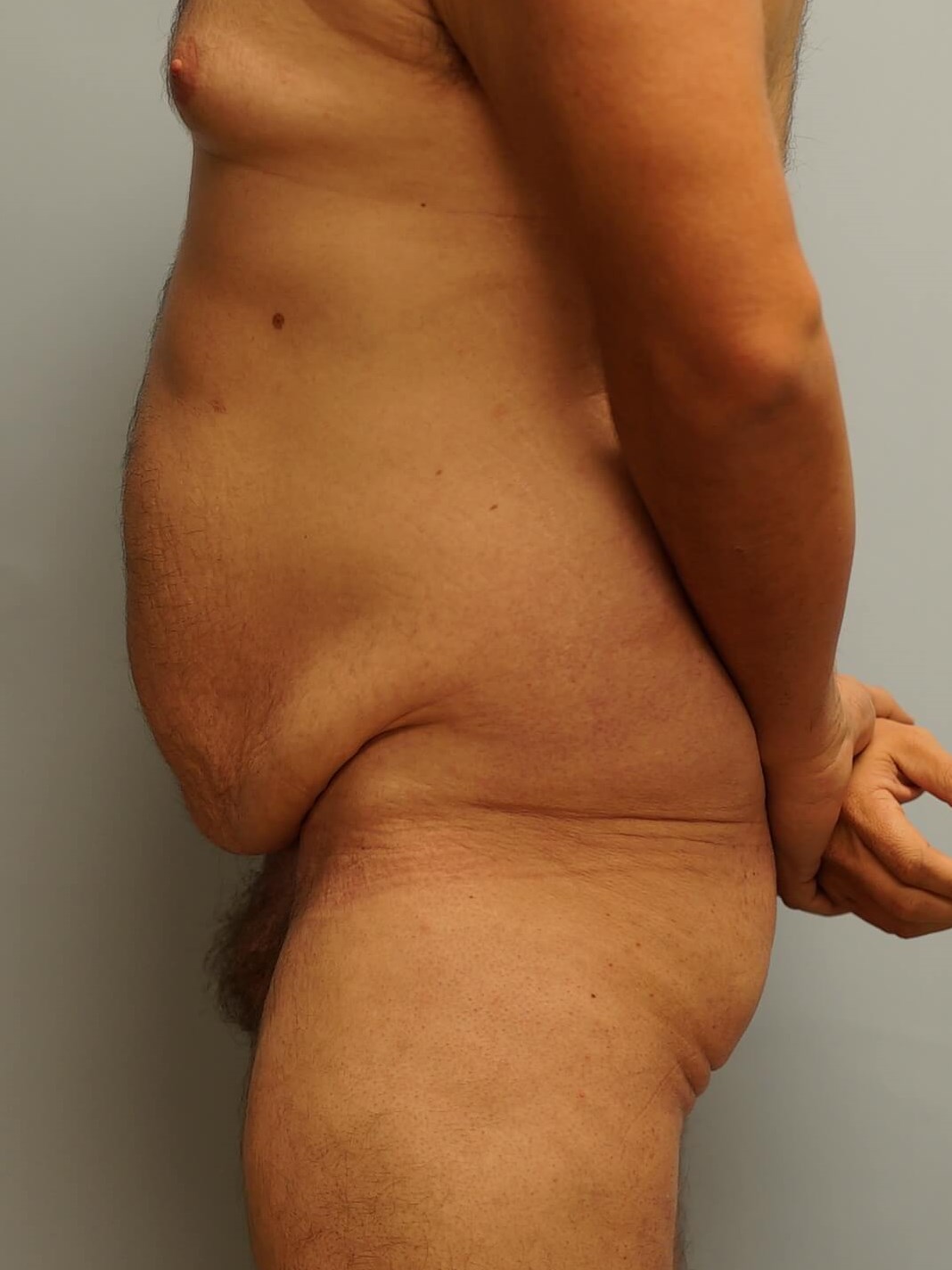 Tummy Tuck post Bariatric Before