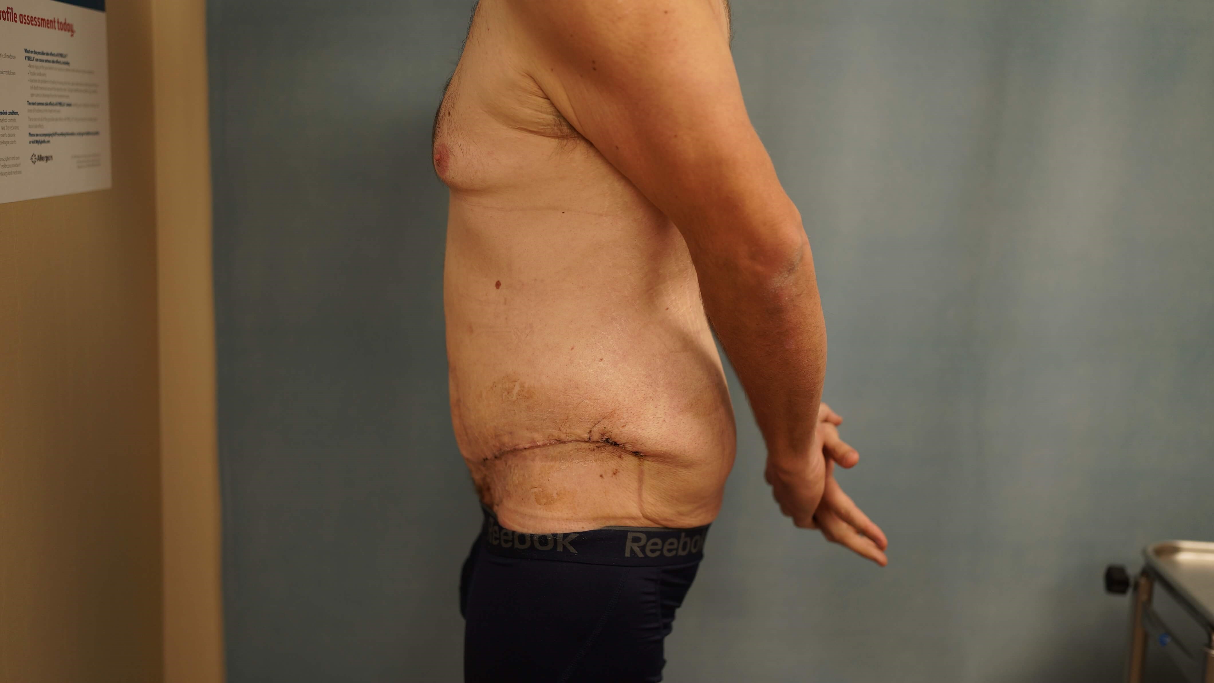 Tummy Tuck post Bariatric After