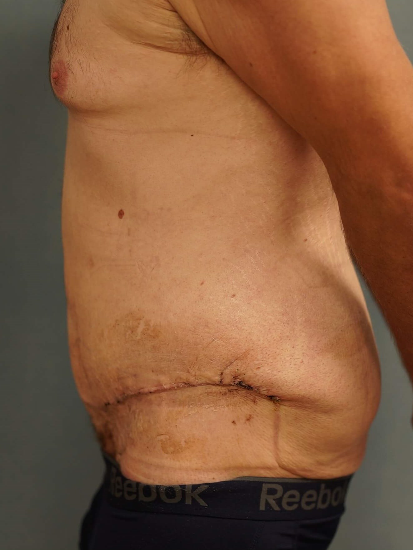 Tummy Tuck post Bariatric After