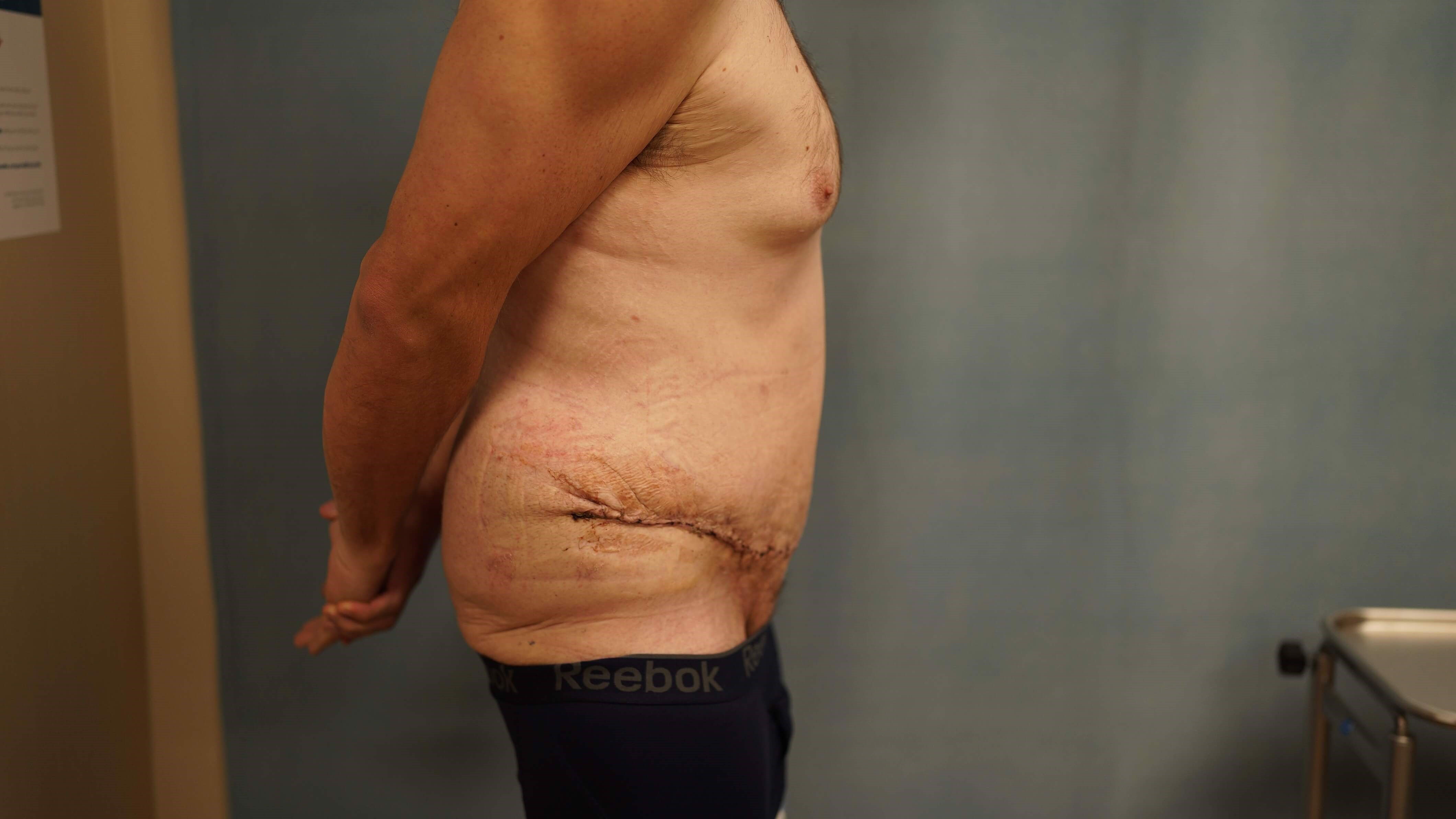 Tummy Tuck post Bariatric After
