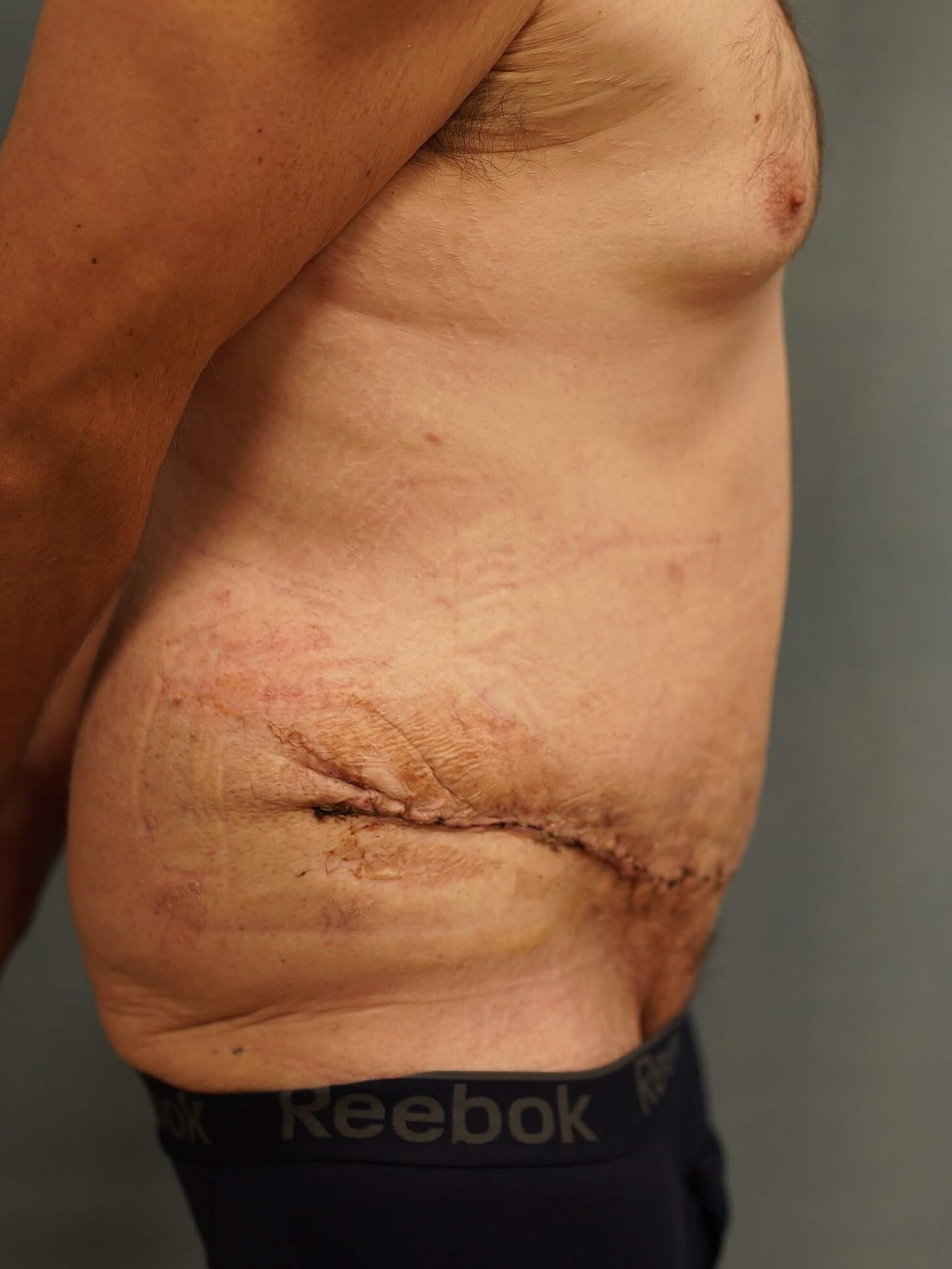 Tummy Tuck post Bariatric After